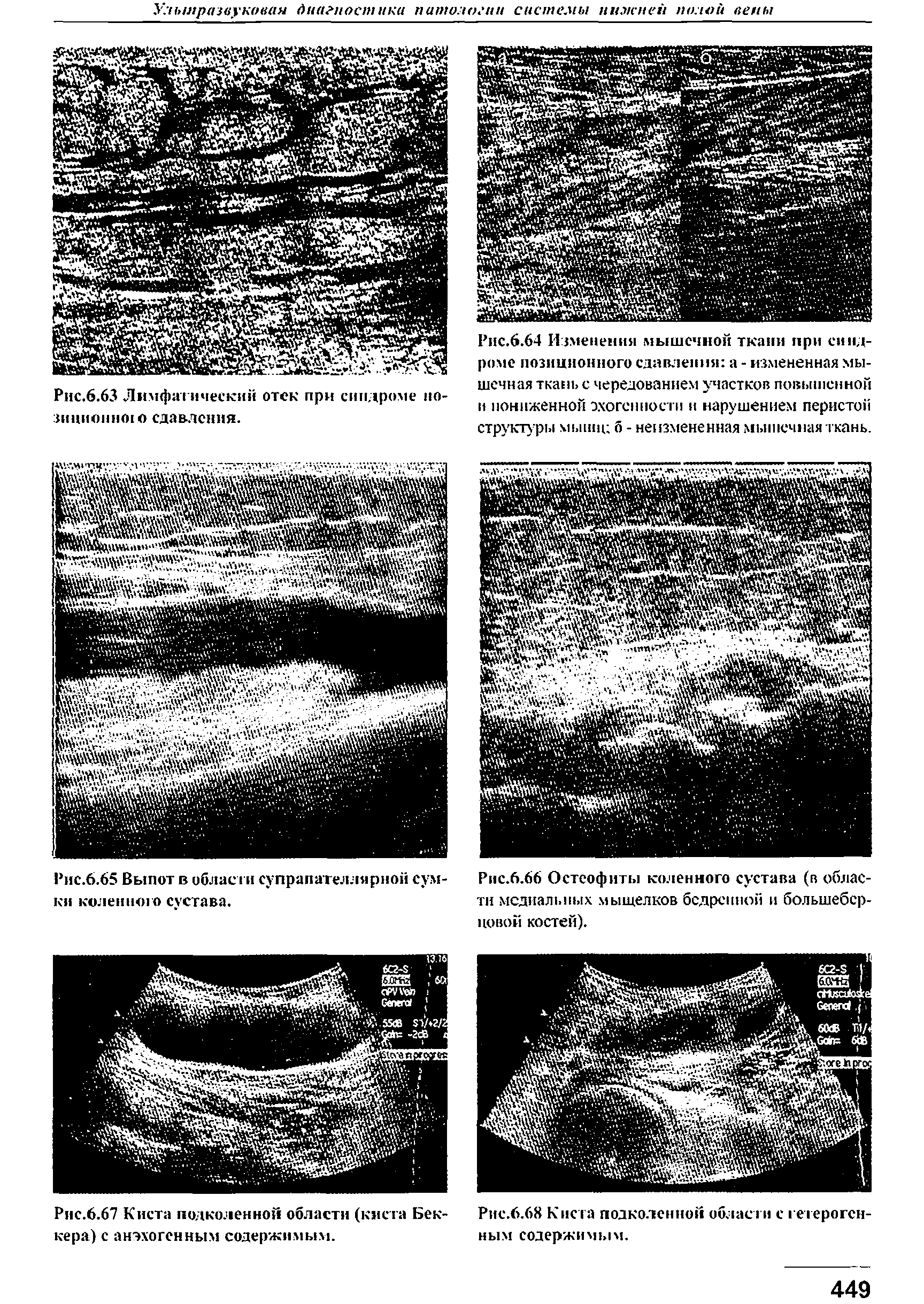 Рис.6.67 Киста подколенной области (киста Беккера) с анэхогенным содержимым.