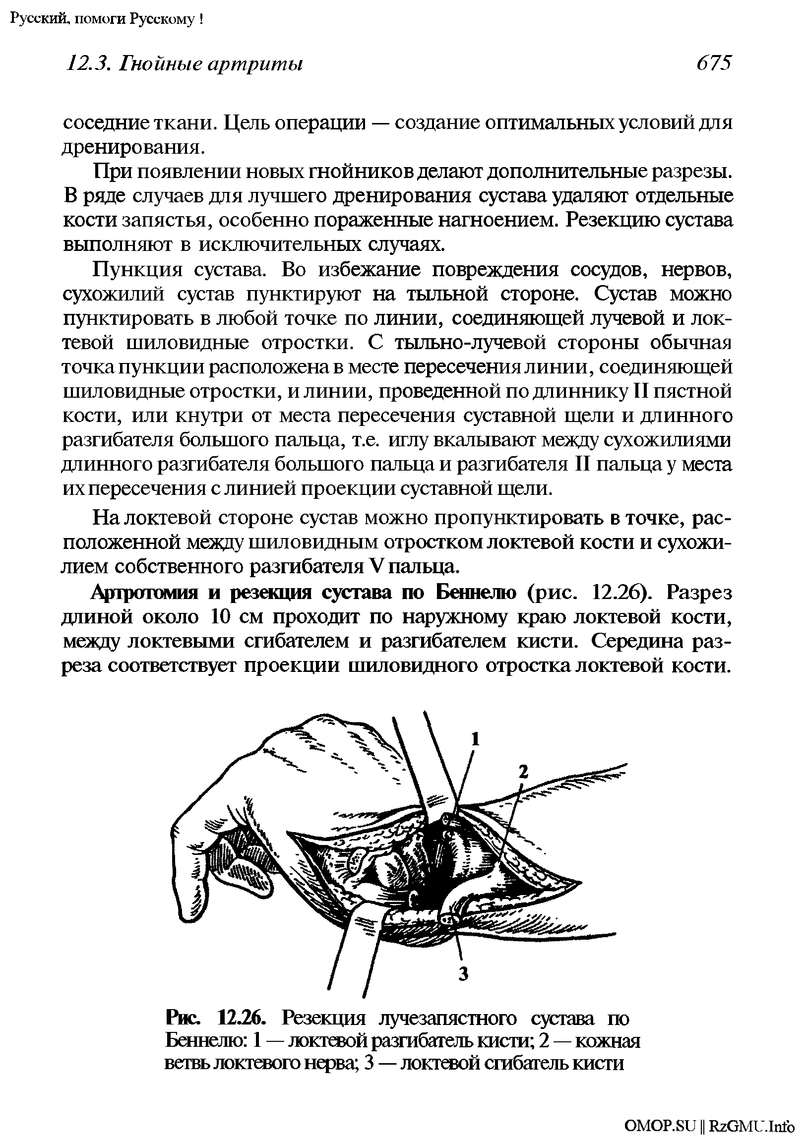 Рис. 12.26. Резекция лучезапястного сустава по Беннелю 1 — локтевой разгибатель кисти 2 — кожная ветвь локтевого нерва 3 — локтевой сгибатель кисти...