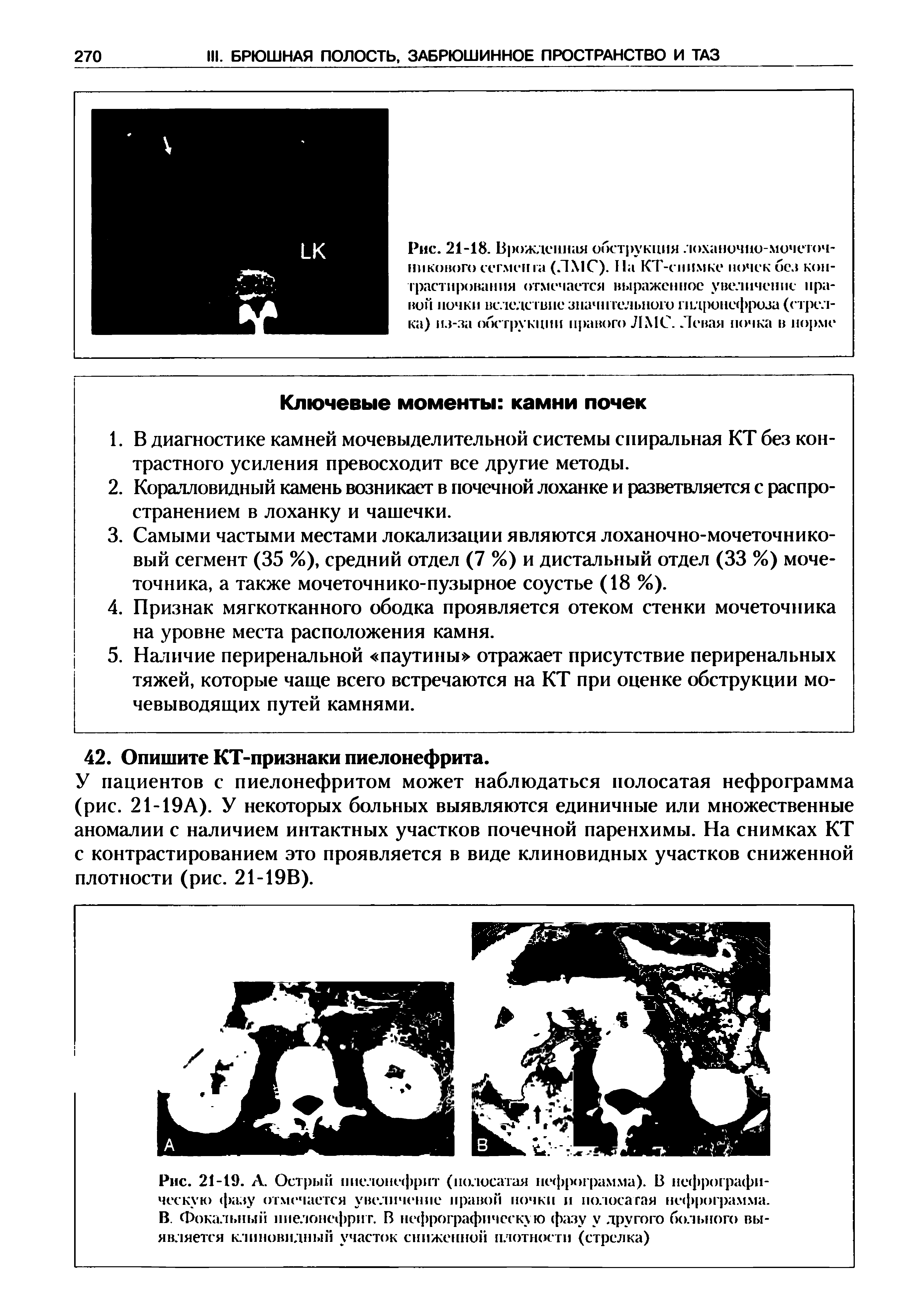 Рис. 21-19. А. Острый пиелонефрит (полосатая нефрограмма). В нефрографи-ческую фазу отмечается увеличение правой почки и полоса гая нефрограмма. В. Фокальный пиелонефрит. В нефрографическую < х1зу у другого больного выявляется клиновидный участок сниженной плотности (стрелка)...