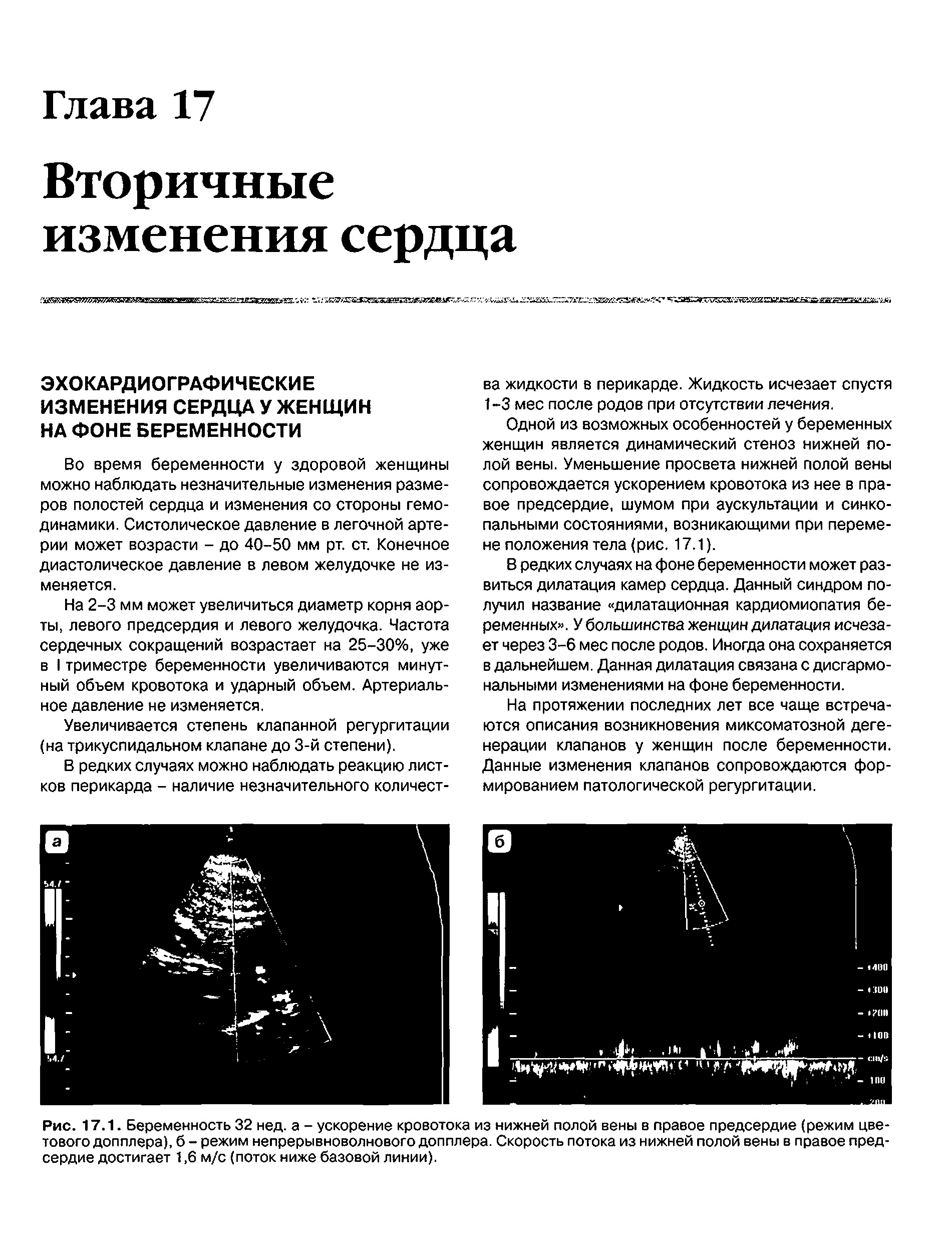 Рис. 17.1. Беременность 32 нед. а - ускорение кровотока из нижней полой вены в правое предсердие (режим цветового допплера), б - режим непрерывноволнового допплера. Скорость потока из нижней полой вены в правое предсердие достигает 1,6 м/с (поток ниже базовой линии).