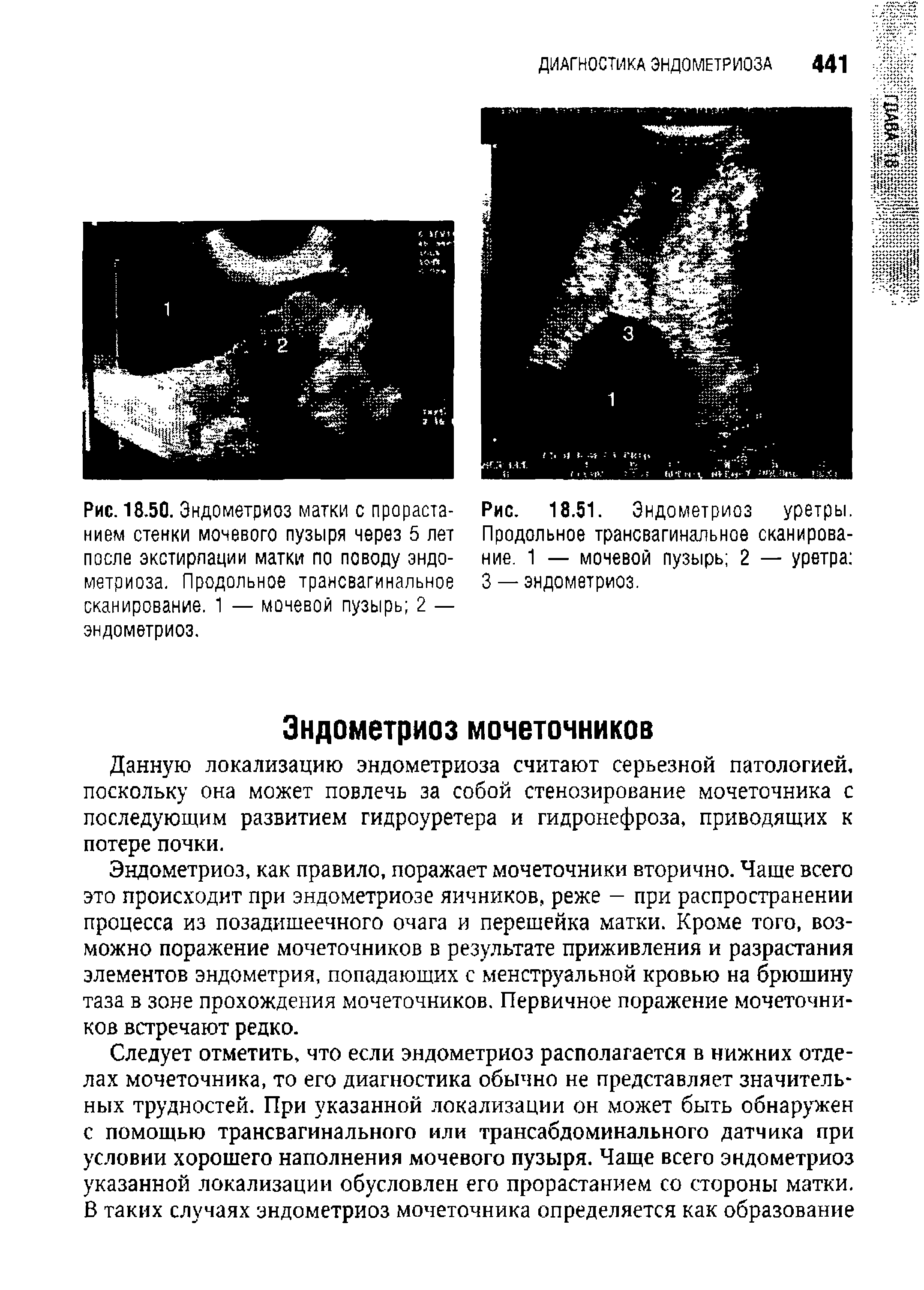 Рис. 18.51. Эндометриоз уретры. Продольное трансвагинальное сканирование. 1 — мочевой пузырь 2 — уретра 3 — эндометриоз.