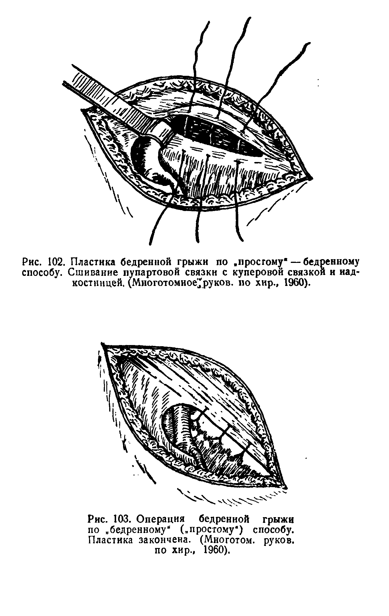 Рис. 103. Операция бедренной грыжи по. бедренному (.простому ) способу. Пластика закончена. (Многотом. руков. по хир., 1960).