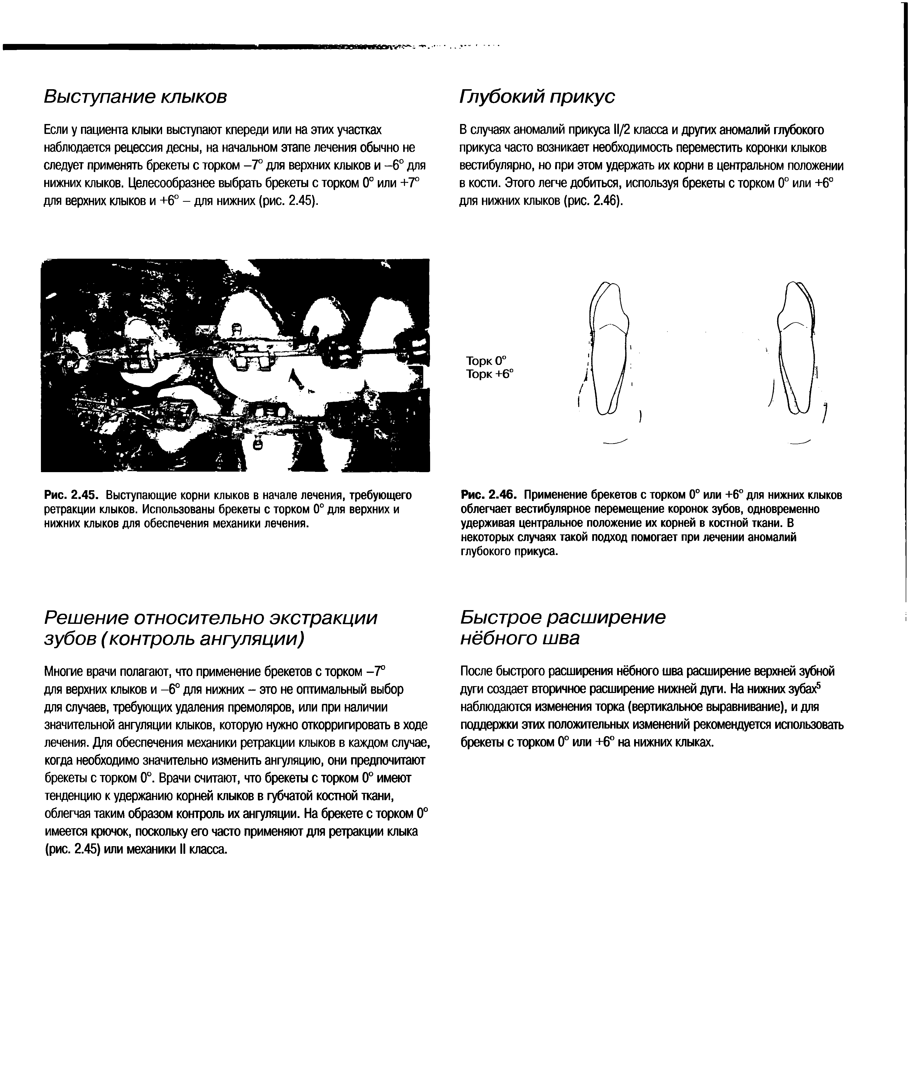 Рис. 2.46. Применение брекетов с торком 0° или +6° для нижних клыков облегчает вестибулярное перемещение коронок зубов, одновременно удерживая центральное положение их корней в костной ткани. В некоторых случаях такой подход помогает при лечении аномалий глубокого прикуса.