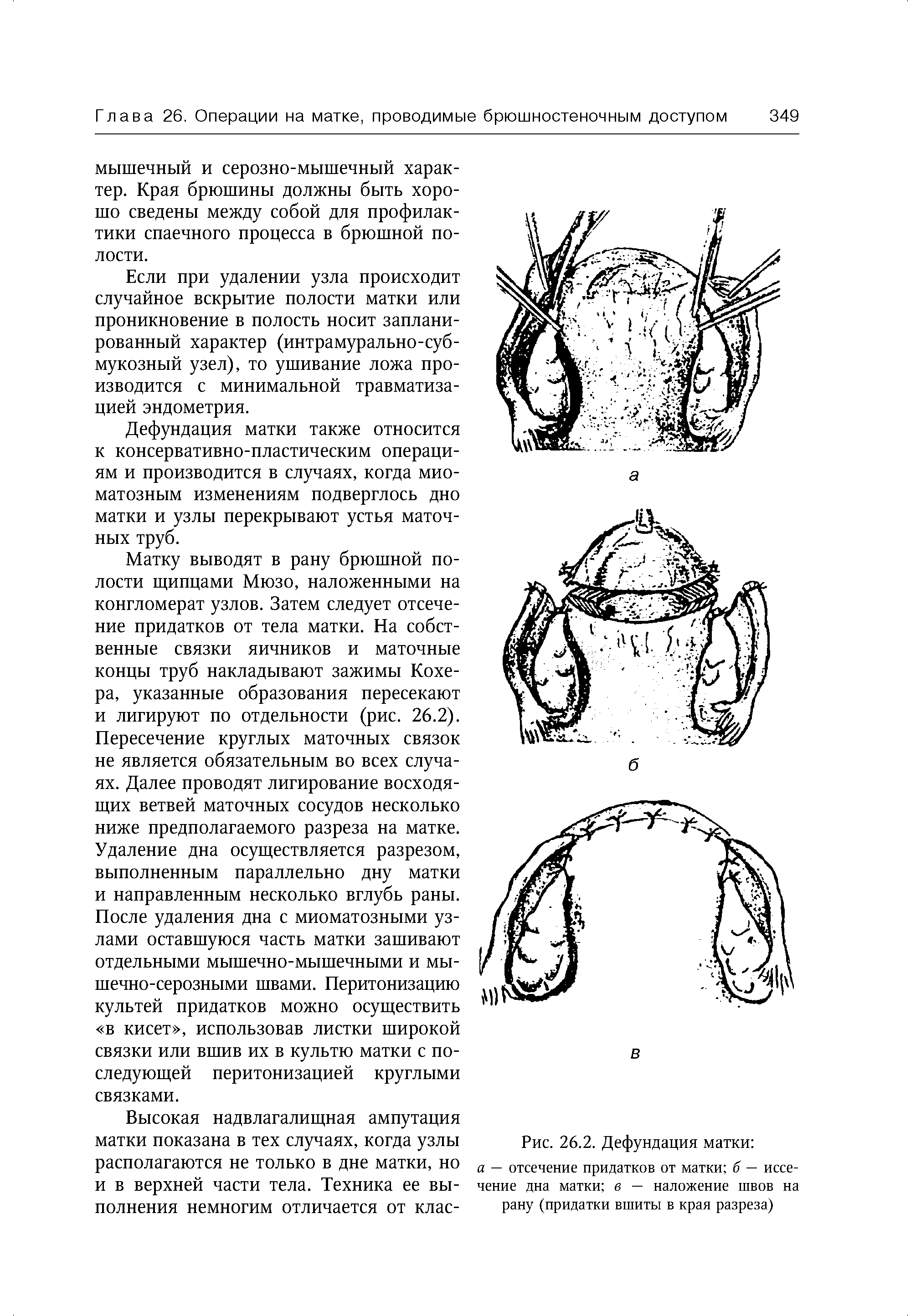 Рис. 26.2. Дефундация матки а — отсечение придатков от матки б — иссечение дна матки в — наложение швов на рану (придатки вшиты в края разреза)...