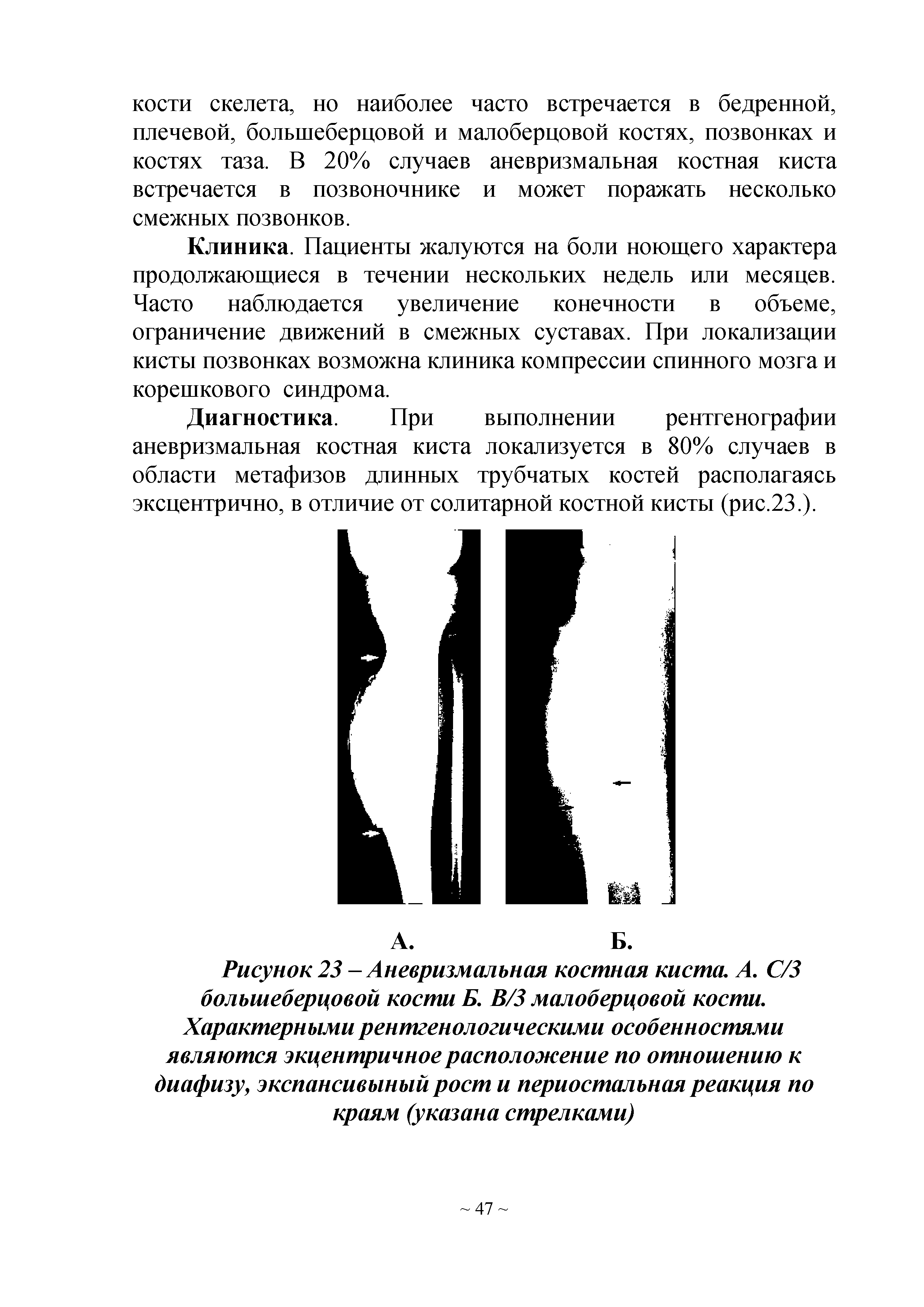 Рисунок 23 -Аневризмальная костная киста. А. С/3 большеберцовой кости Б. В/3 малоберцовой кости. Характерными рентгенологическими особенностями являются экцентричноерасположение по отношению к диафизу, экспансивыный рост и периостальная реакция по краям (указана стрелками)...