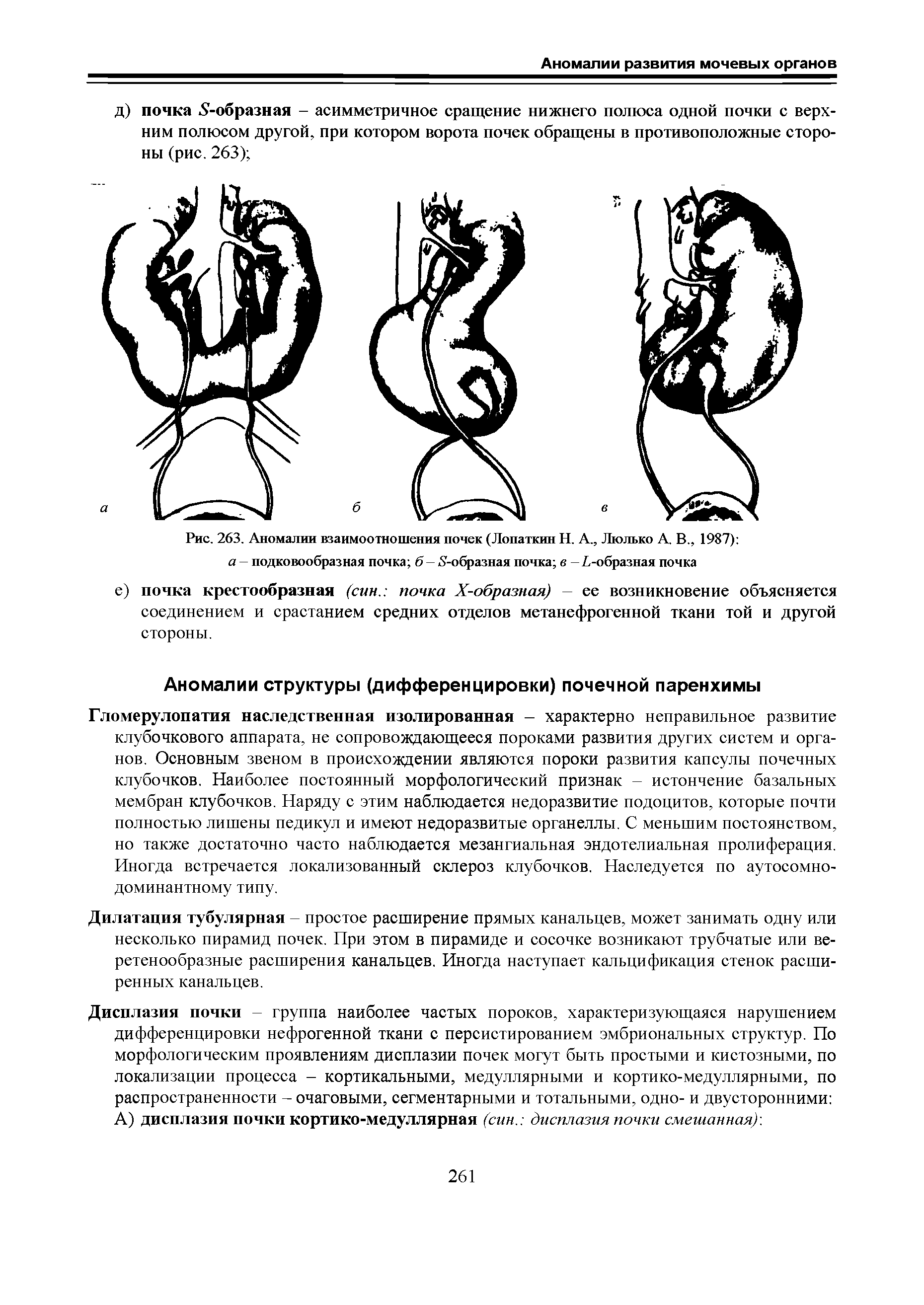 Рис. 263. Аномалии взаимоотношения почек (Лопаткин Н. А., Люлько А. В., 1987) а — подковообразная почка 5 — 5-образная почка в — -образная почка...