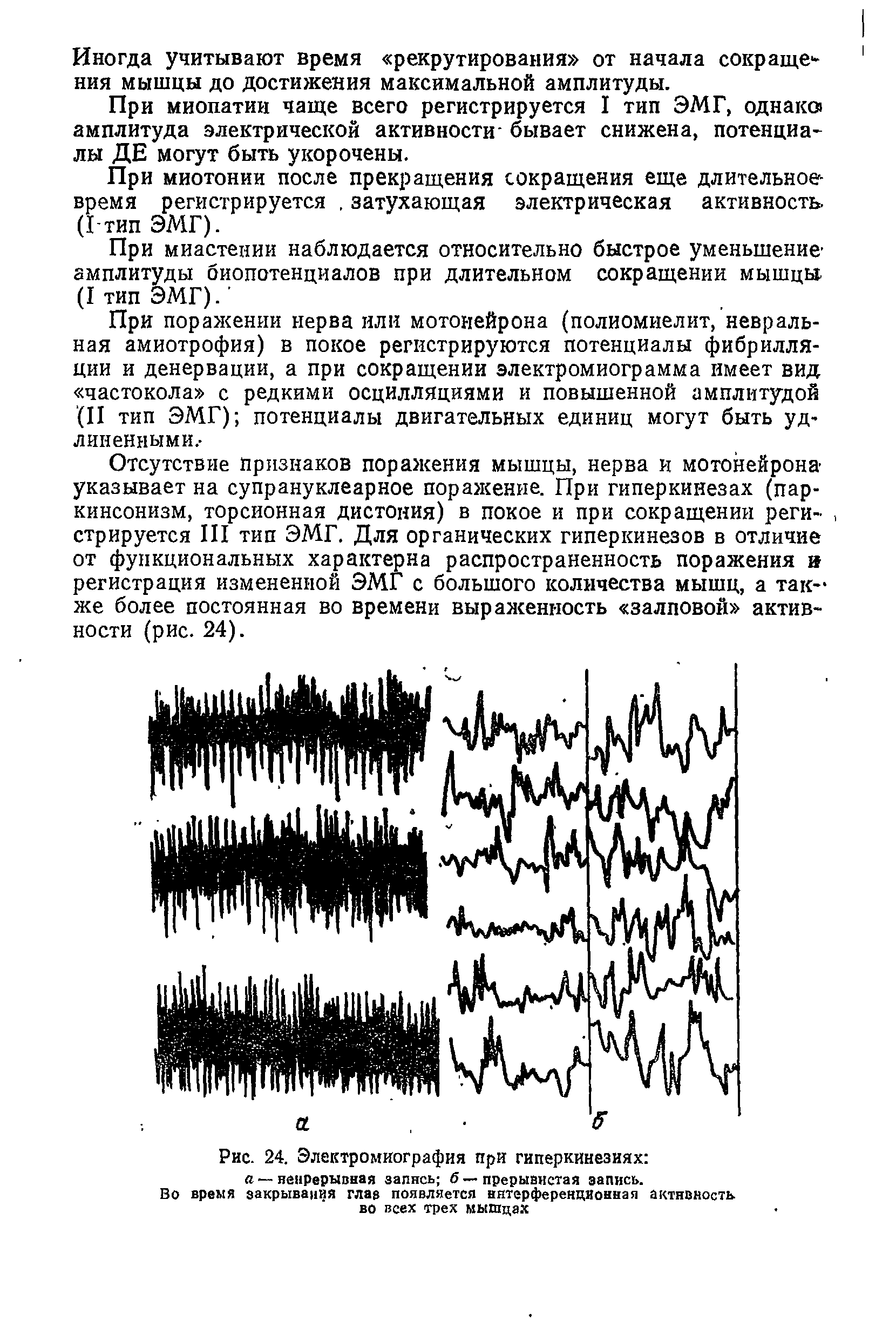 Рис. 24. Электромиография при гиперкинезиях а — непрерывная запись б — прерывистая запись.