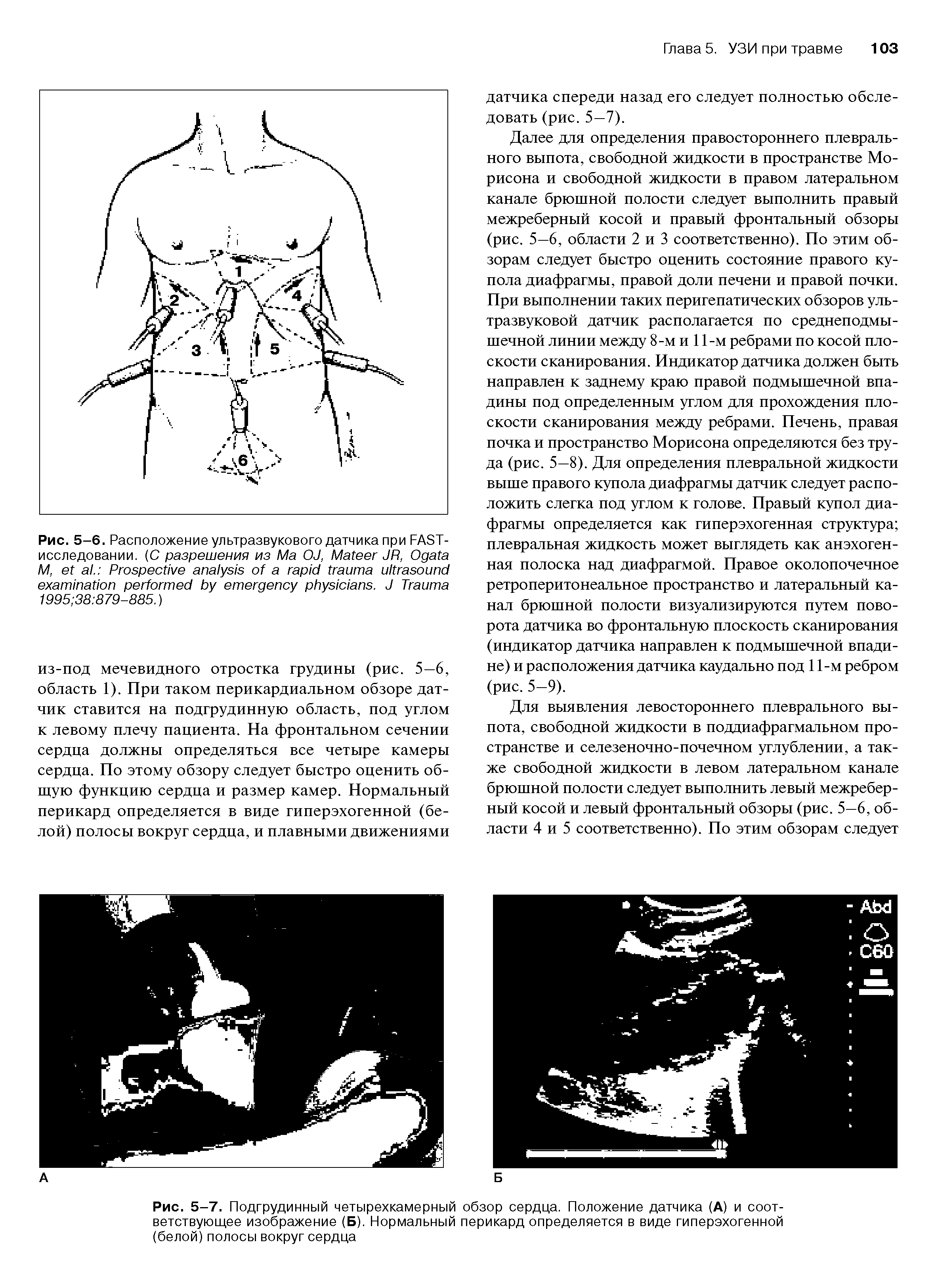 Рис. 5-7. Подгрудинный четырехкамерный обзор сердца. Положение датчика (А) и соответствующее изображение (Б). Нормальный перикард определяется в виде гиперэхогенной (белой) полосы вокруг сердца...