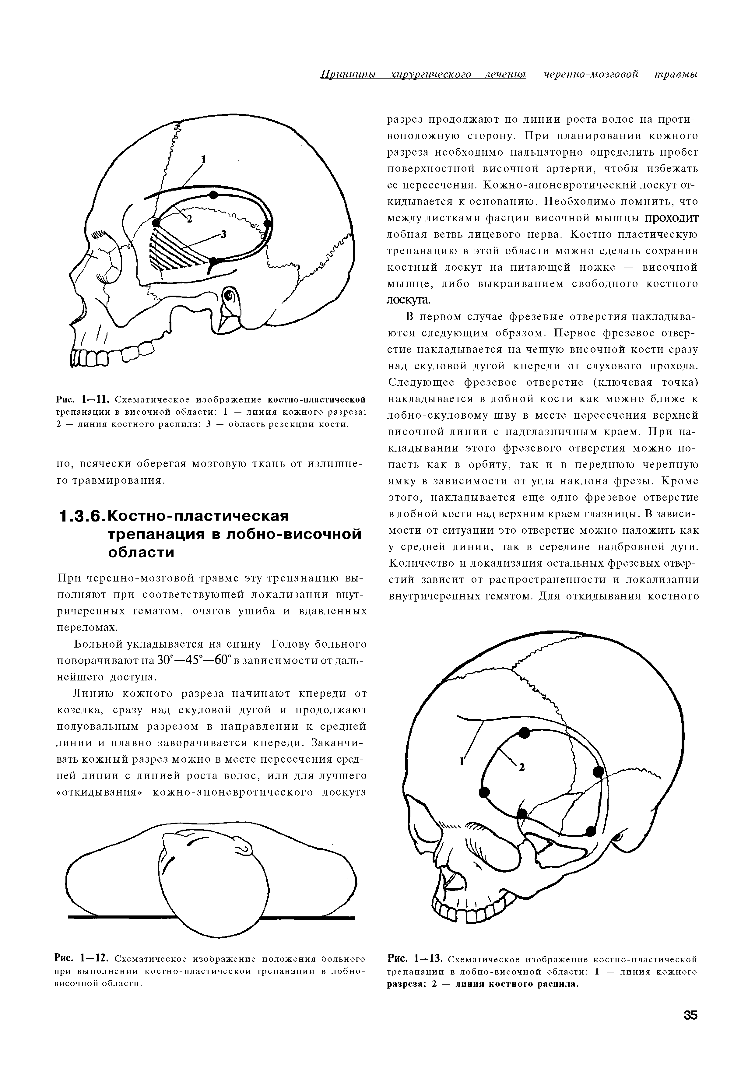 Рис. 1-13. Схематическое изображение костно-пластической трепанации в лобно-височной области 1 — линия кожного разреза 2 — линия костного распила.