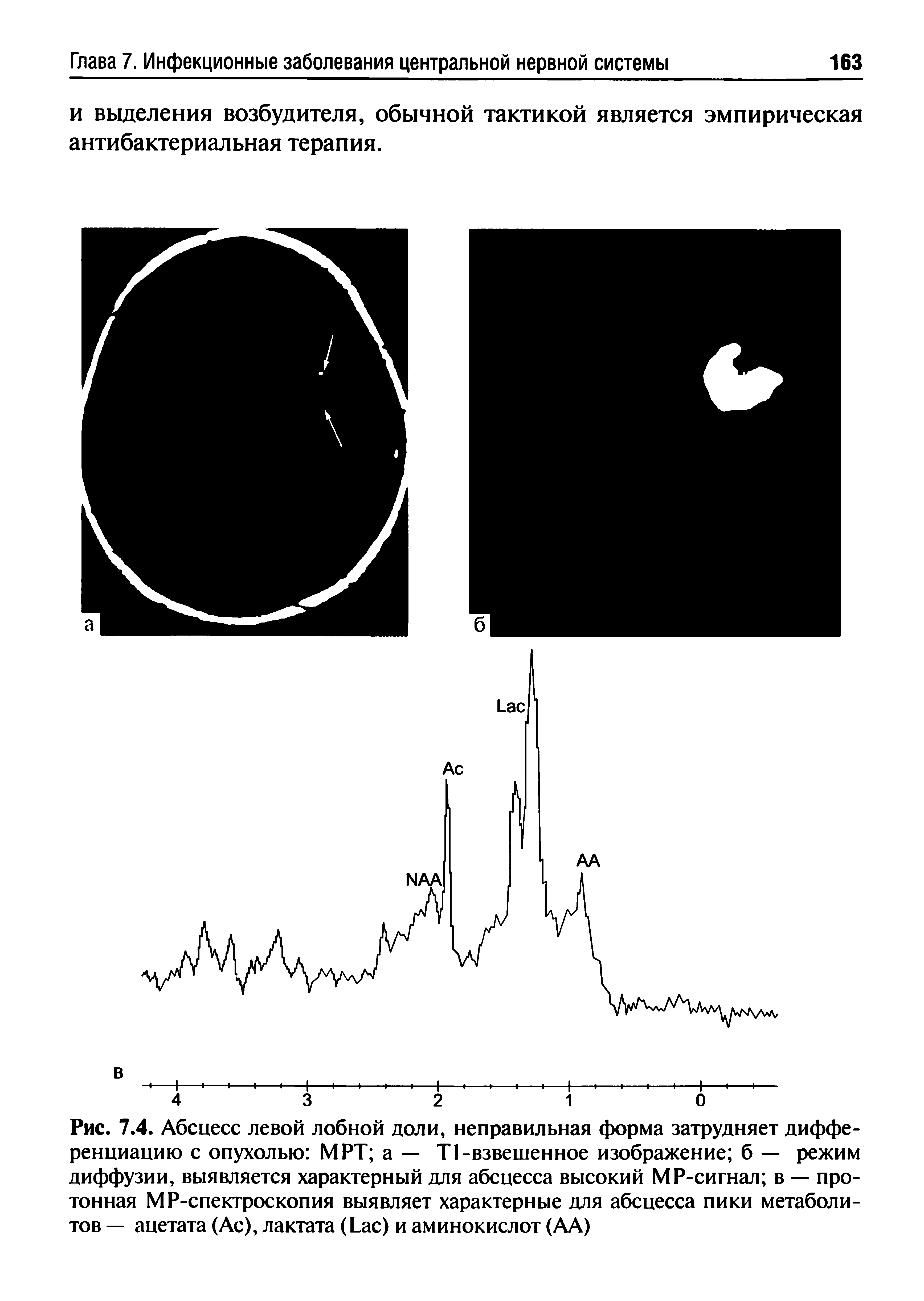 Рис. 7.4. Абсцесс левой лобной доли, неправильная форма затрудняет дифференциацию с опухолью MPT а — Т1-взвешенное изображение б — режим диффузии, выявляется характерный для абсцесса высокий MP-сигнал в — протонная MP-спектроскопия выявляет характерные для абсцесса пики метаболитов — ацетата (Ас), лактата (L ) и аминокислот (АА)...