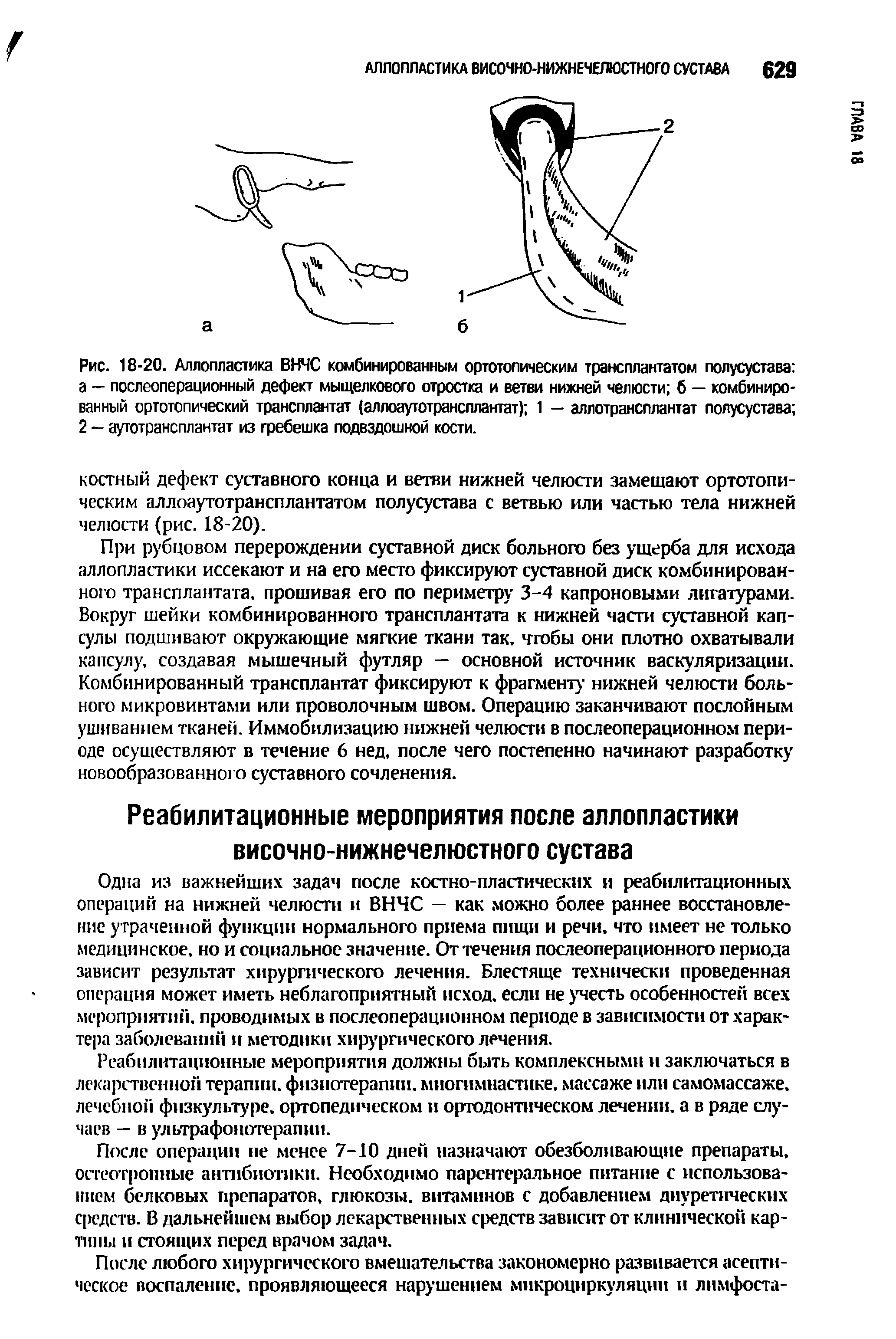 Рис. 18-20. Аллопластика ВНЧС комбинированным ортотопическим трансплантатом полусустава а — послеоперационный дефект мыщелкового отростка и ветви нижней челюсти б — комбинированный ортотопический трансплантат (аллоаутотрансплантат) 1 — аллотрансплантат полусустава 2 — аутотрансплантат из гребешка подвздошной кости.