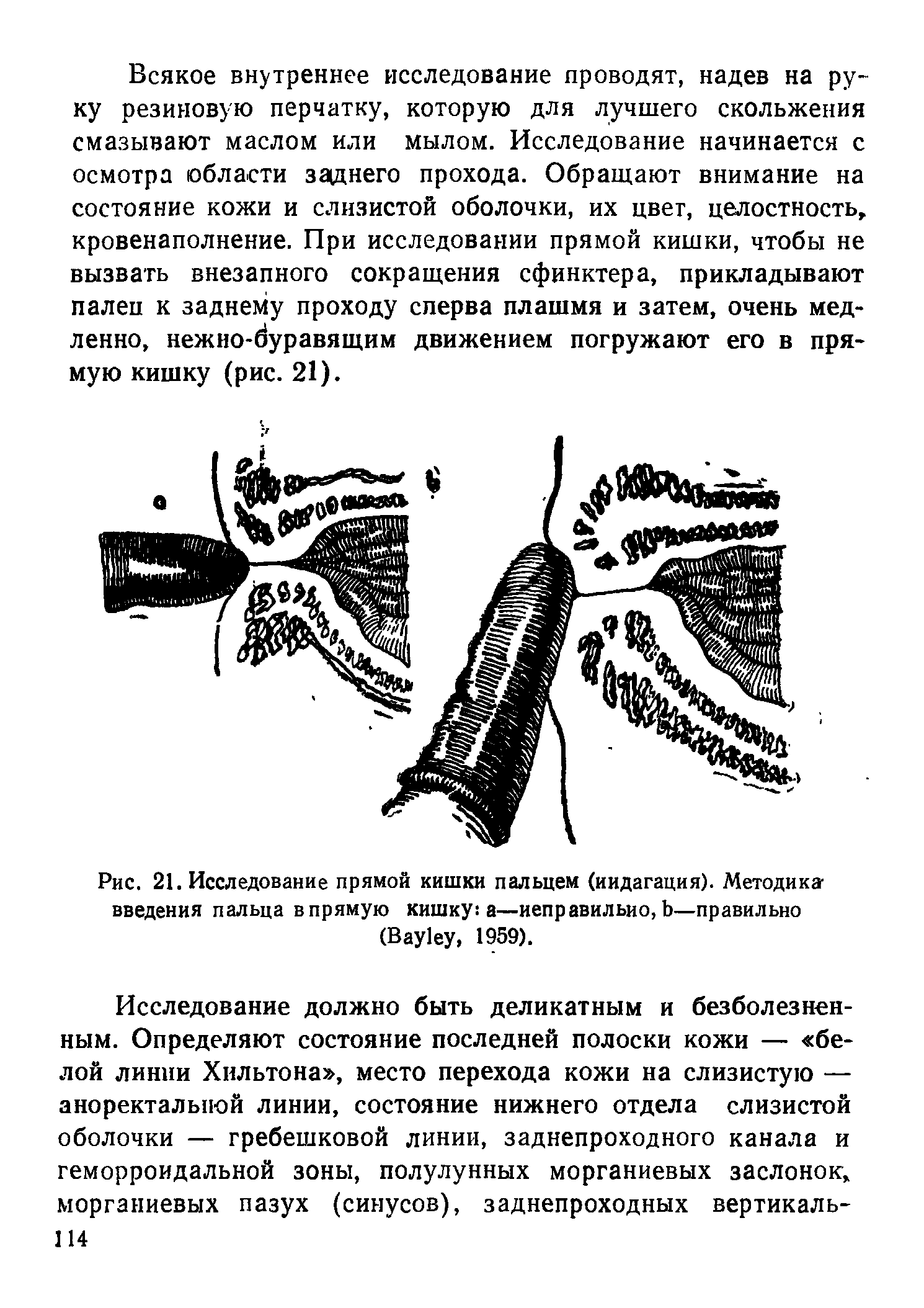 Рис. 21. Исследование прямой кишки пальцем (иидагация). Методика введения пальца впрямую кишку а—неправильно, Ь—правильно (B , 1959).