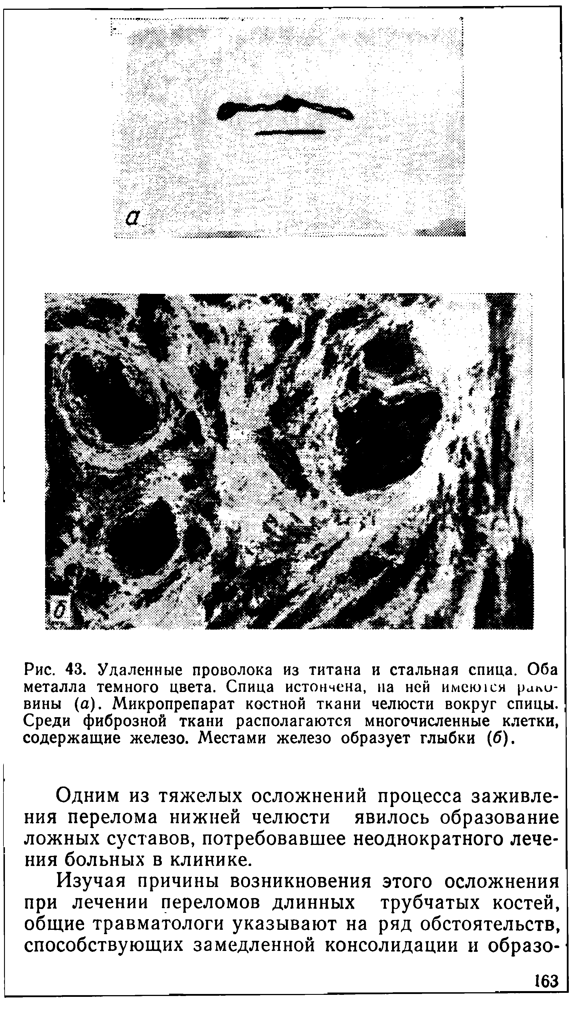 Рис. 43. Удаленные проволока из титана и стальная спица. Оба металла темного цвета. Спица истончена, на ней имени ся рали-вины (а). Микропрепарат костной ткани челюсти вокруг спицы. Среди фиброзной ткани располагаются многочисленные клетки, содержащие железо. Местами железо образует глыбки (б).