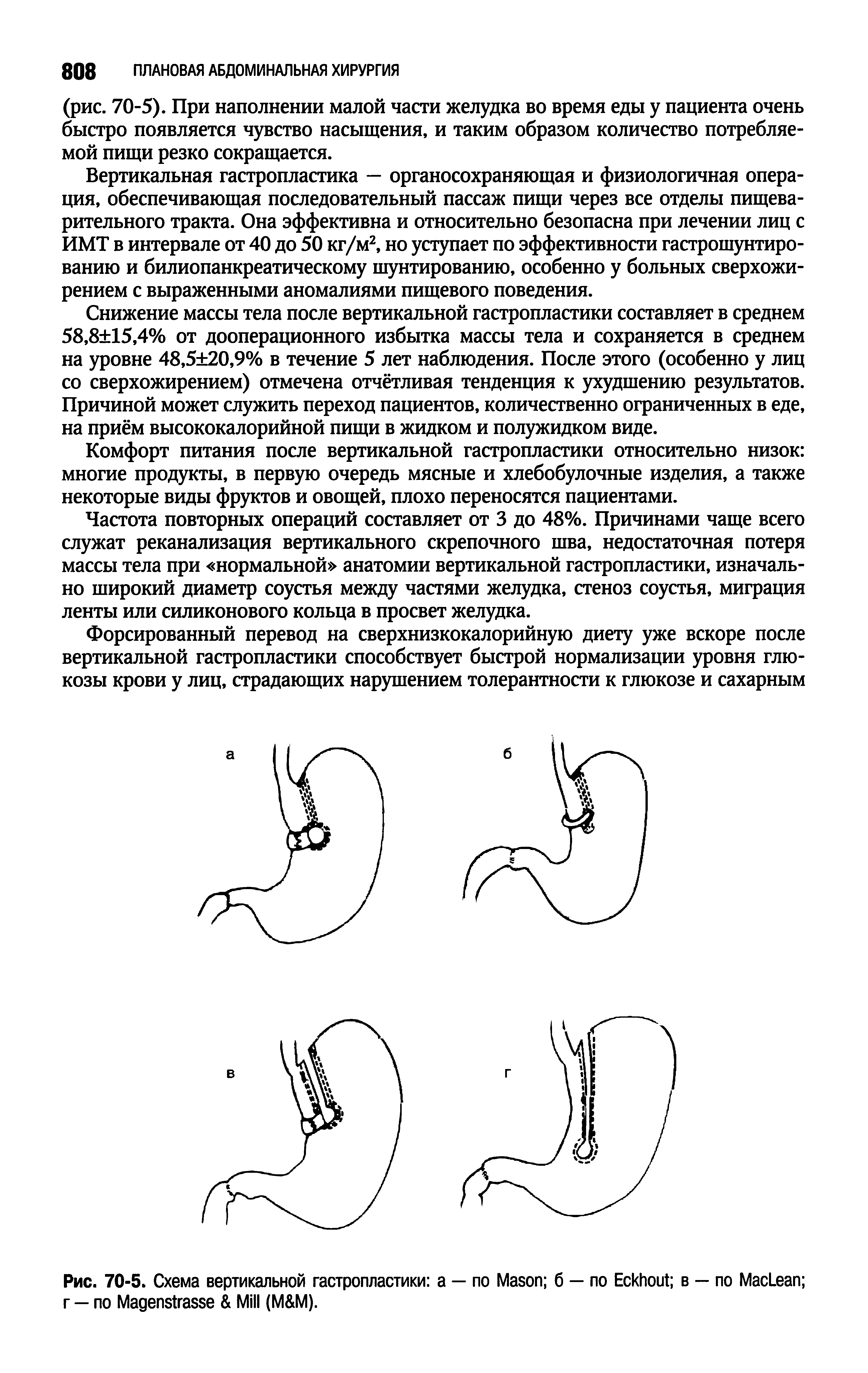 Рис. 70-5. Схема вертикальной гастропластики а — по M б — по E в — по M L г — по M M (М М).