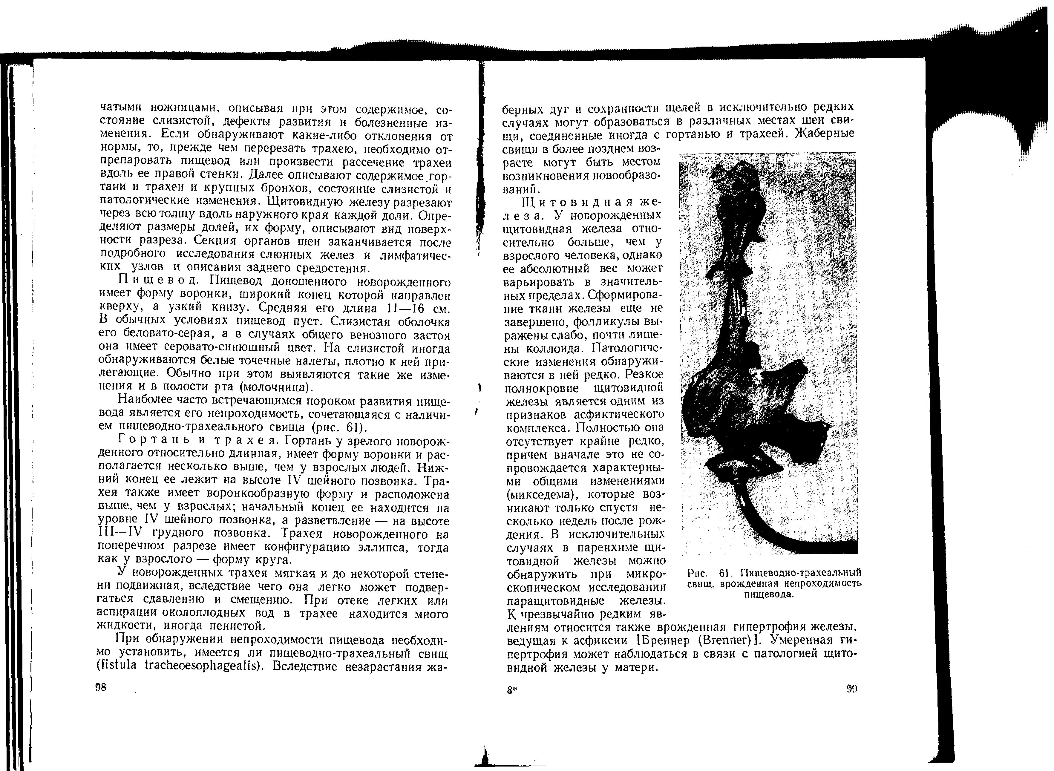 Рис. 61. Пищеводно-трахеальный свищ, врожденная непроходимость пищевода.