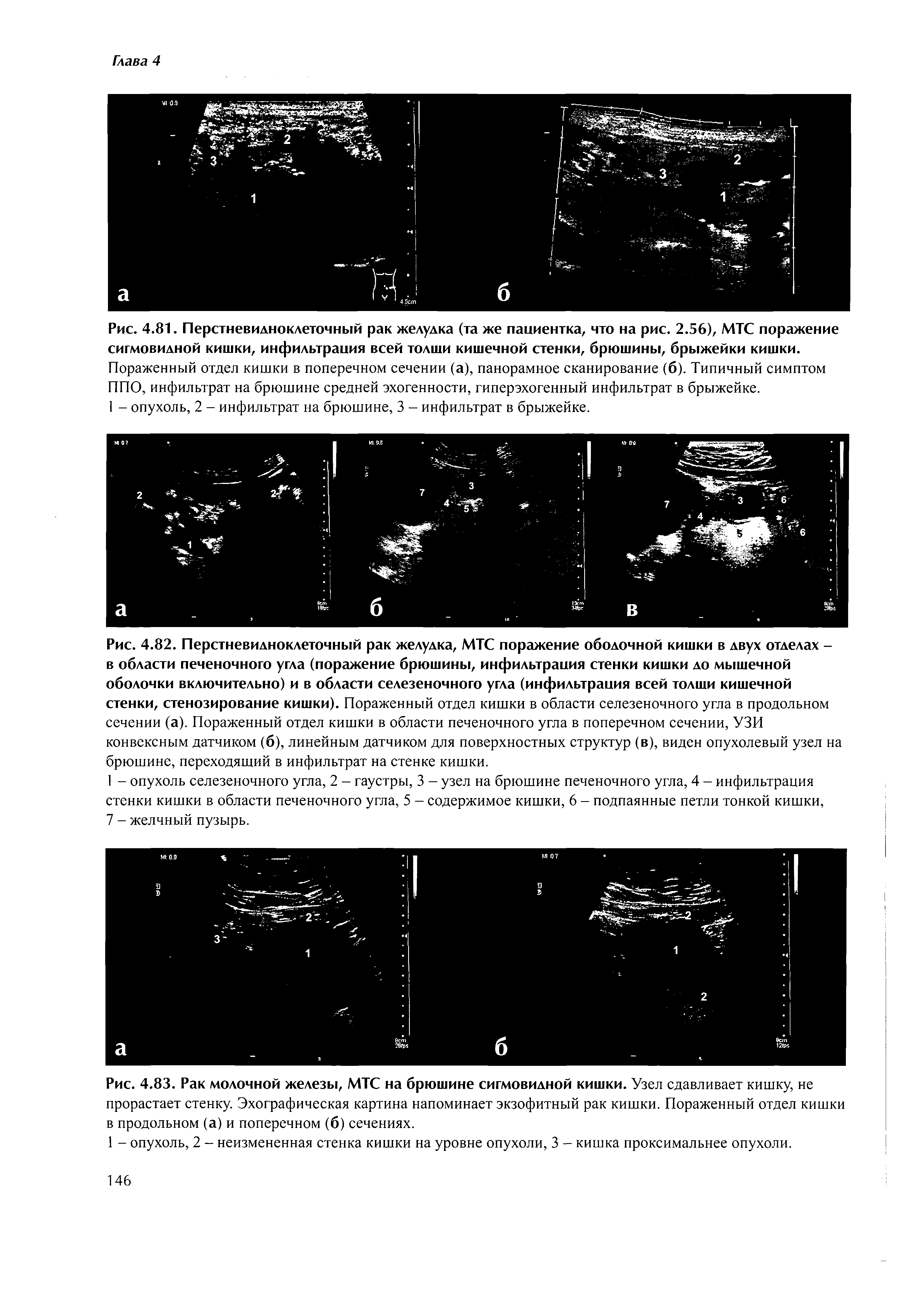 Рис. 4.81. Перстневидноклеточный рак желудка (та же пациентка, что на рис. 2.56), МТС поражение сигмовидной кишки, инфильтрация всей толши кишечной стенки, брюшины, брыжейки кишки. Пораженный отдел кишки в поперечном сечении (а), панорамное сканирование (б). Типичный симптом ППО, инфильтрат на брюшине средней эхогенности, гиперэхогенный инфильтрат в брыжейке.