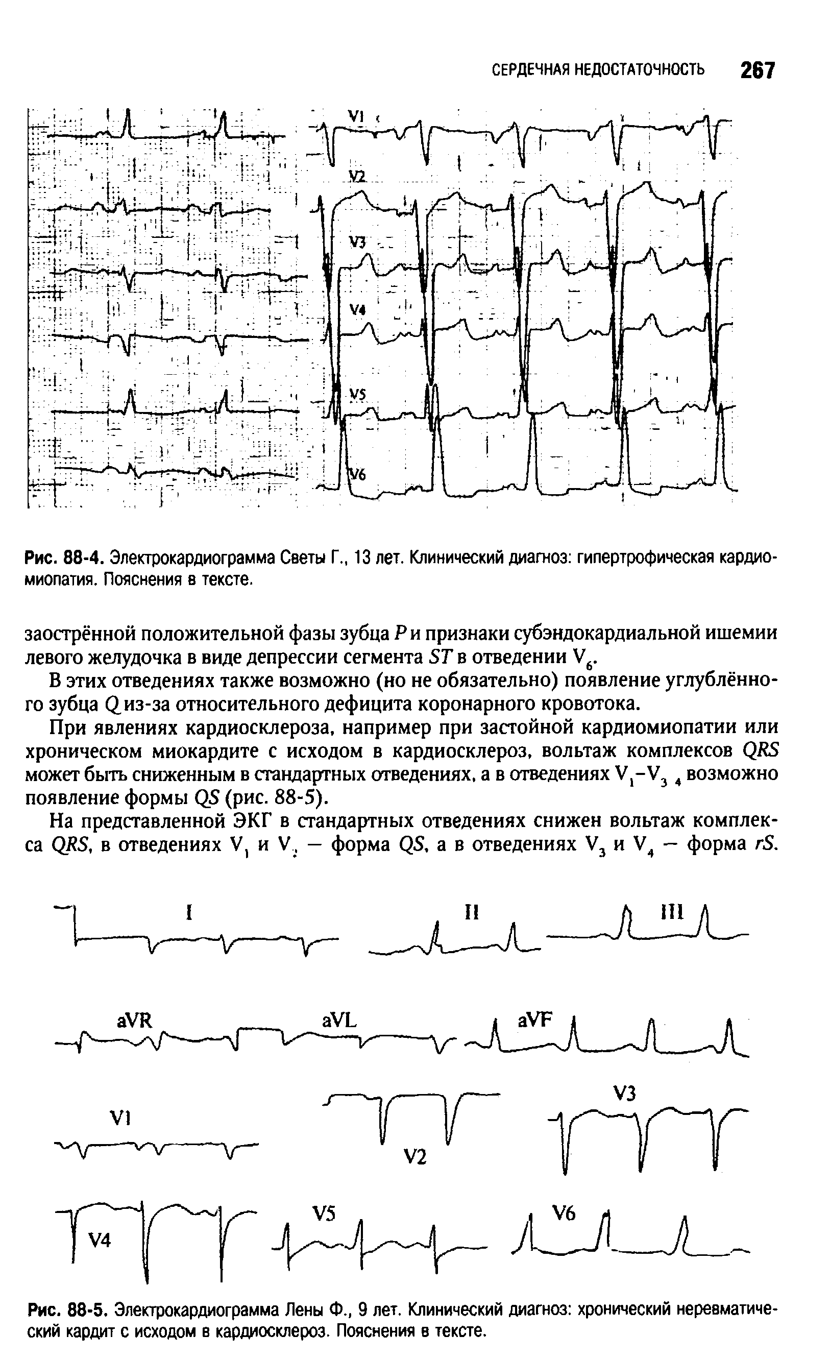 Рис. 88-4. Электрокардиограмма Светы Г., 13 лет. Клинический диагноз гипертрофическая кардиомиопатия. Пояснения в тексте.