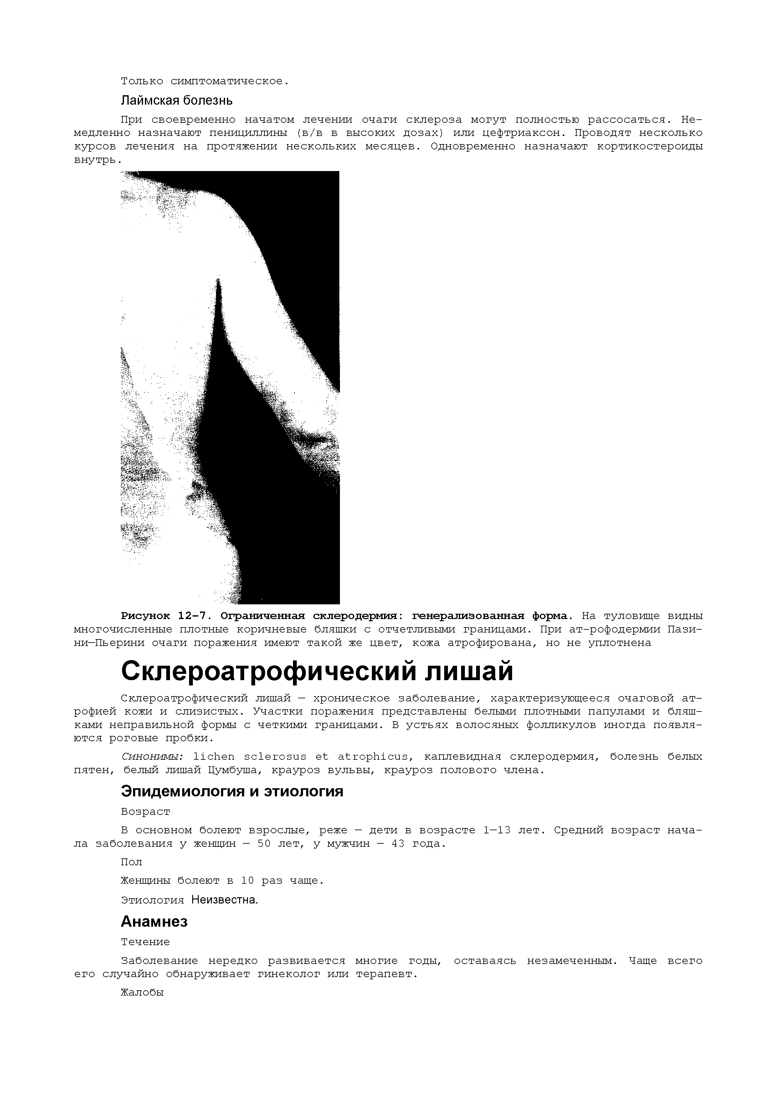 Рисунок 12-7. Ограниченная склеродермия генерализованная форма. На туловище видны многочисленные плотные коричневые бляшки с отчетливыми границами. При ат-рофодермии Пази-ни—Пьерини очаги поражения имеют такой же цвет, кожа атрофирована, но не уплотнена...