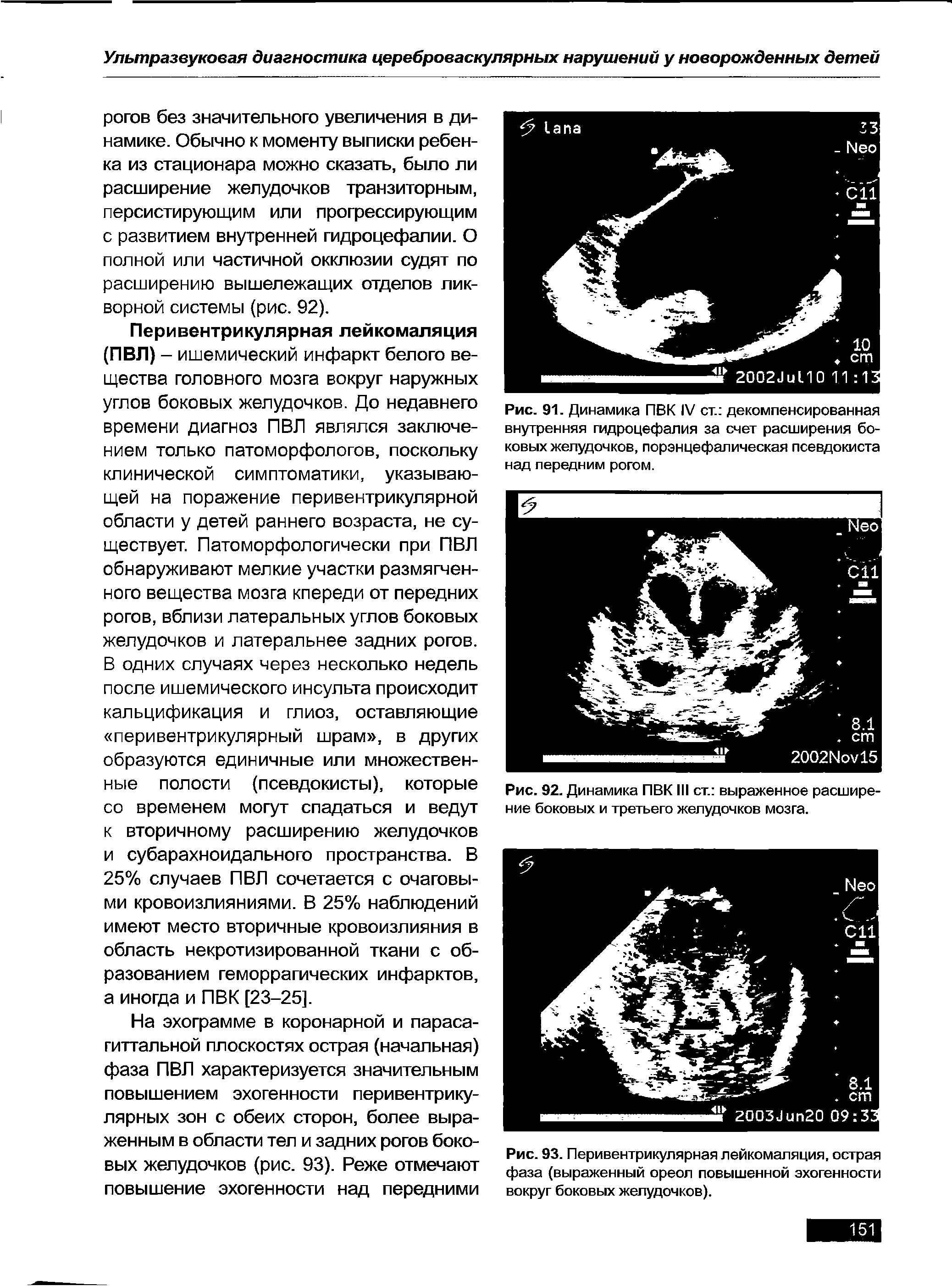 Рис. 93. Перивентрикулярная лейкомаляция, острая фаза (выраженный ореол повышенной эхогенности вокруг боковых желудочков).