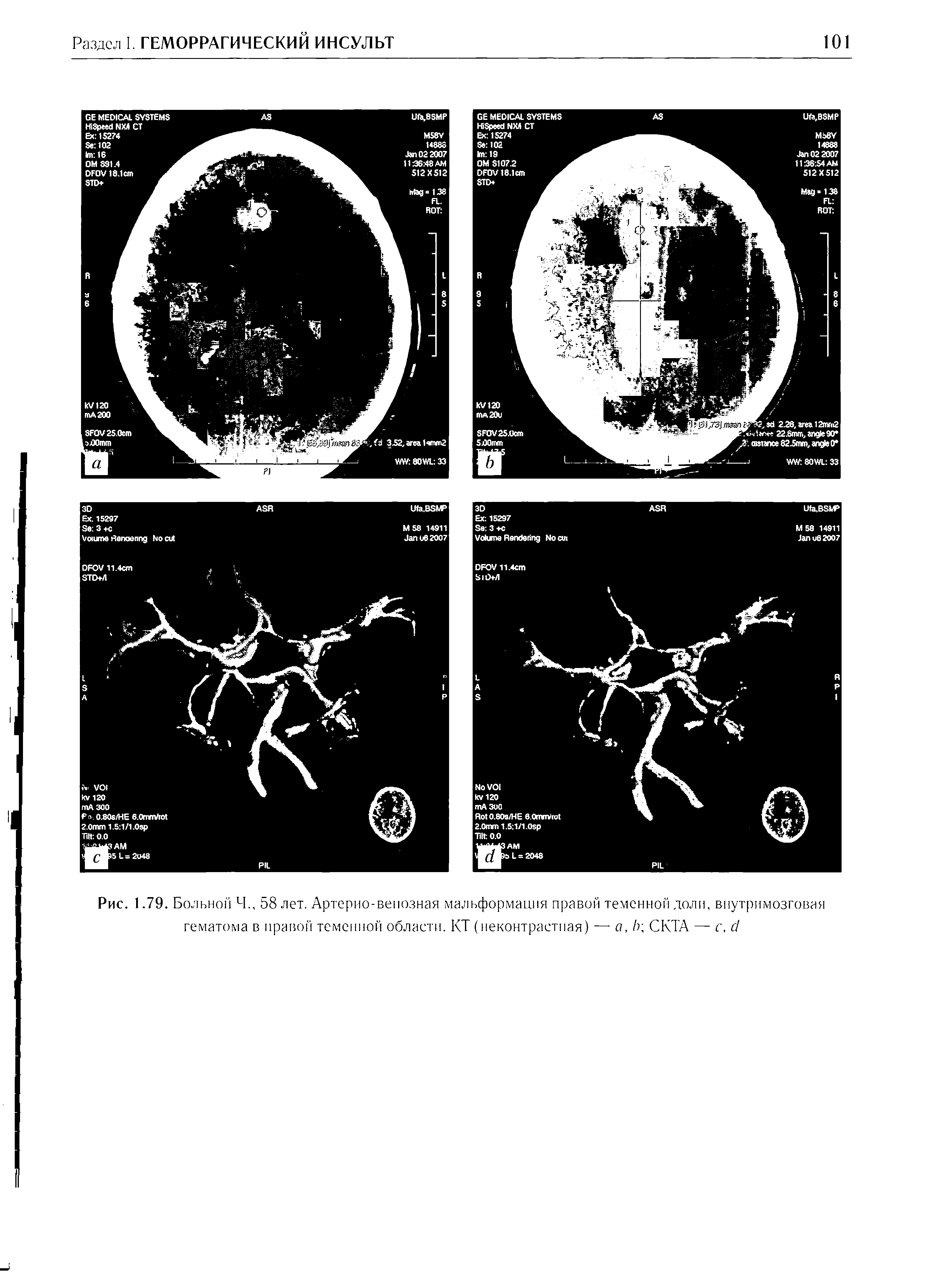 Рис. 1.79. Больной Ч., 58 лет. Артерио-венозная мальформация правой теменной доли, внутримозговая...