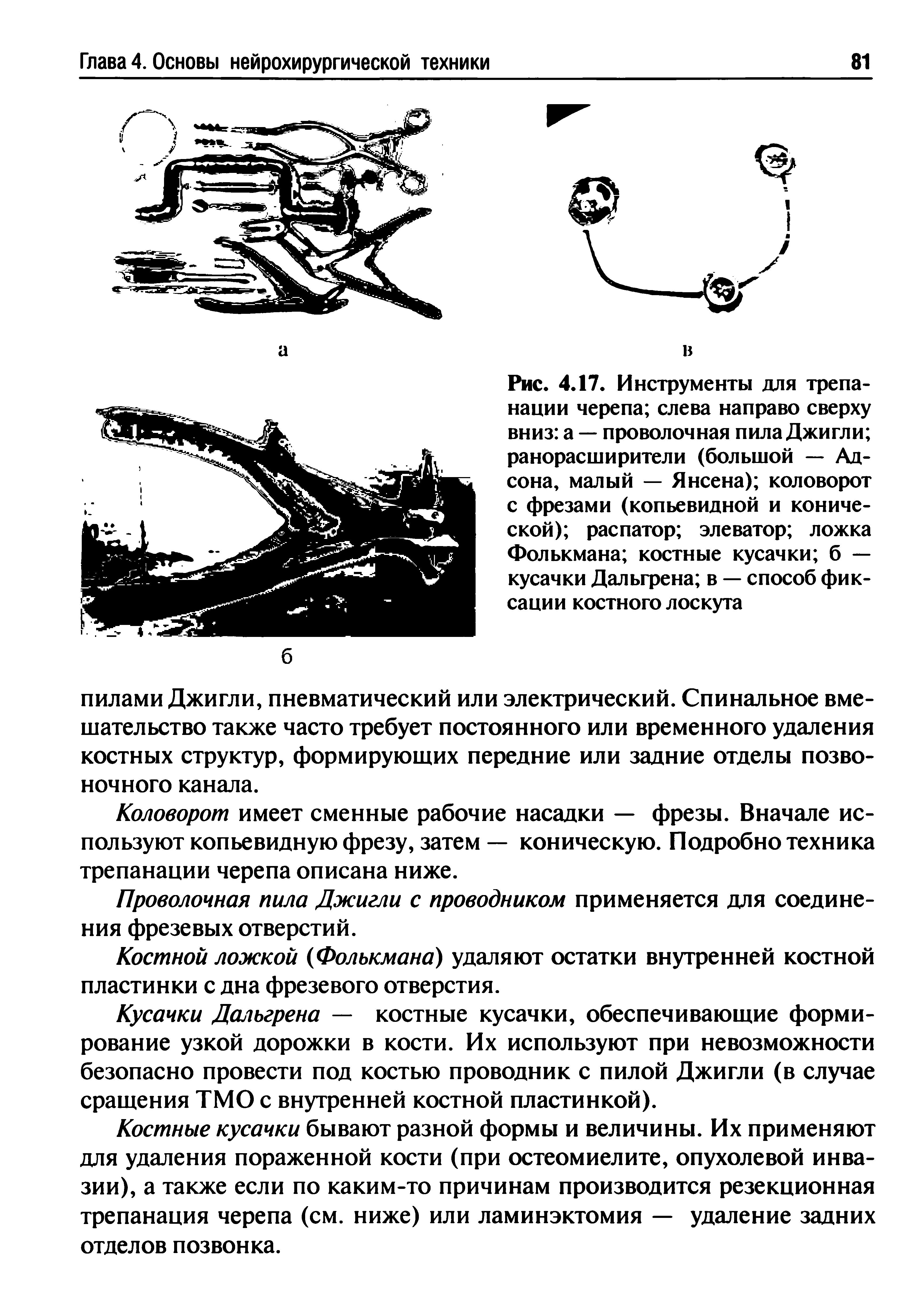 Рис. 4.17. Инструменты для трепанации черепа слева направо сверху вниз а — проволочная пила Джигли ранорасширители (большой — Адсона, малый — Янсена) коловорот с фрезами (копьевидной и конической) распатор элеватор ложка Фолькмана костные кусачки б — кусачки Дальгрена в — способ фиксации костного лоскута...