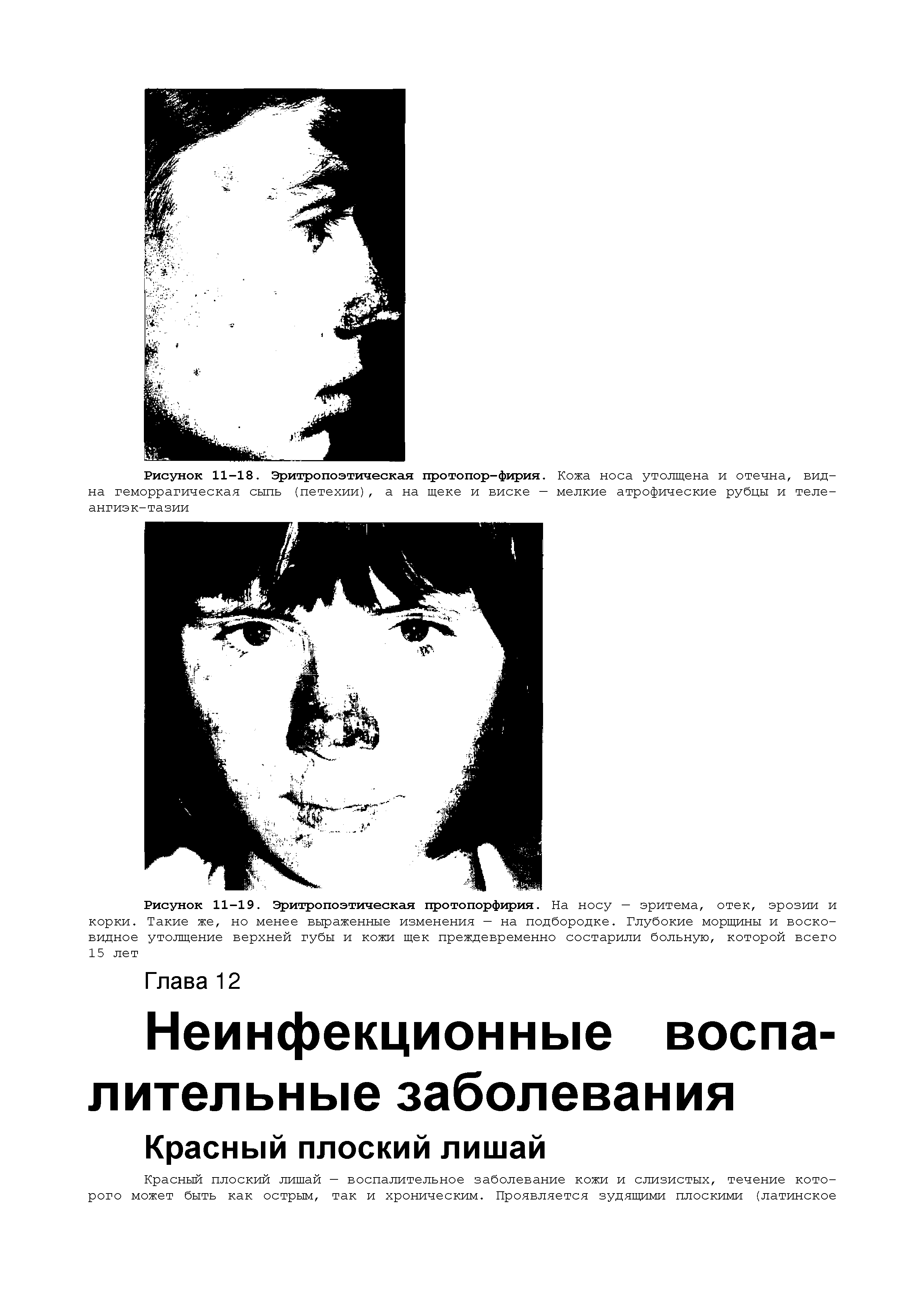 Рисунок 11-19. Эритропоэтическая протопорфирия. На носу — эритема, отек, эрозии и корки. Такие же, но менее выраженные изменения — на подбородке. Глубокие морщины и восковидное утолщение верхней губы и кожи щек преждевременно состарили больную, которой всего 15 лет...