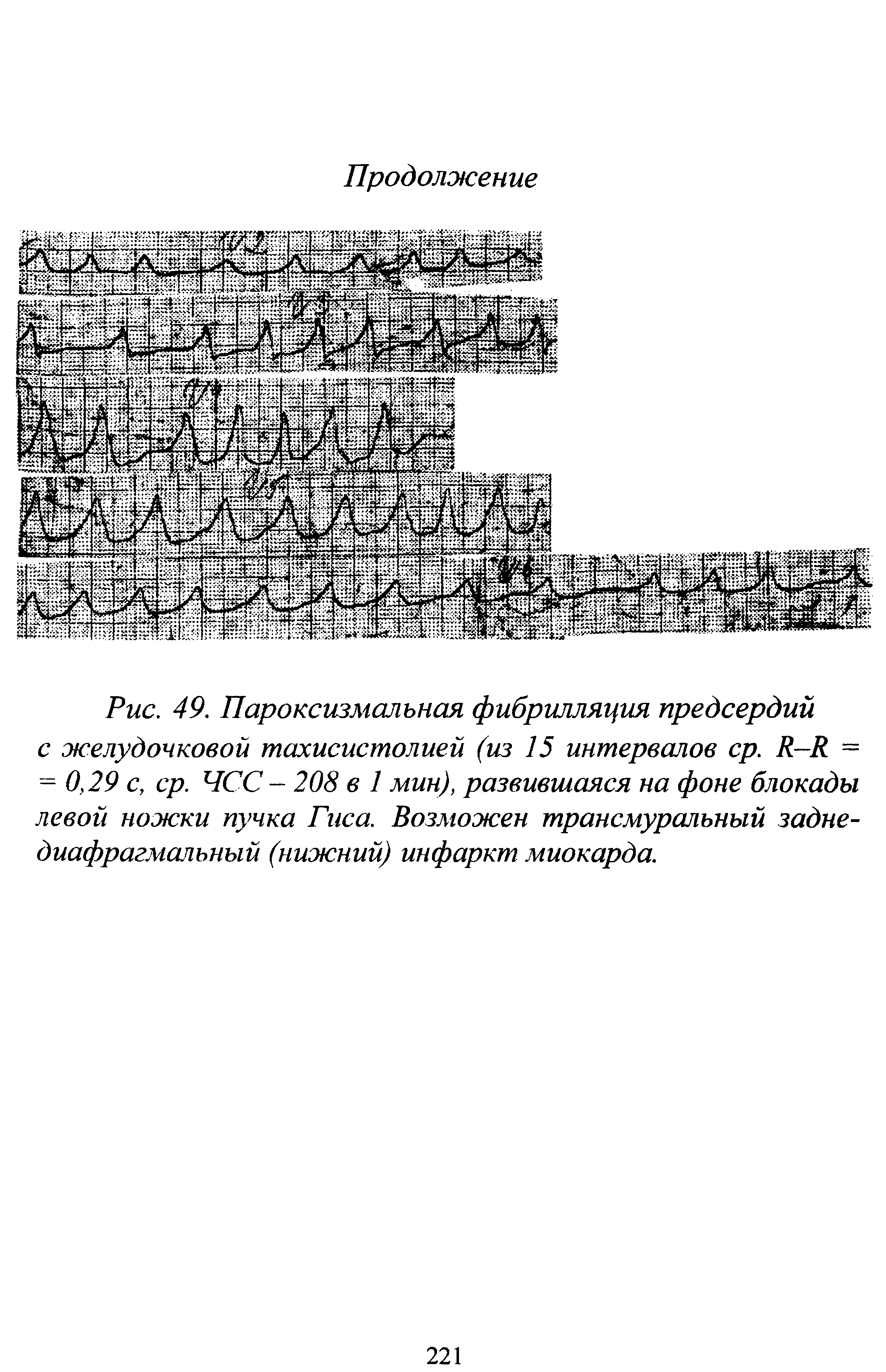 Рис. 49. Пароксизмальная фибрилляция предсердий с желудочковой тахисистолией (из 15 интервалов ср. В-В. = = 0,29 с, ср. ЧСС - 208 в 1 мин), развившаяся на фоне блокады левой ножки пучка Гиса. Возможен трансмуральный заднедиафрагмальный (нижний) инфаркт миокарда.