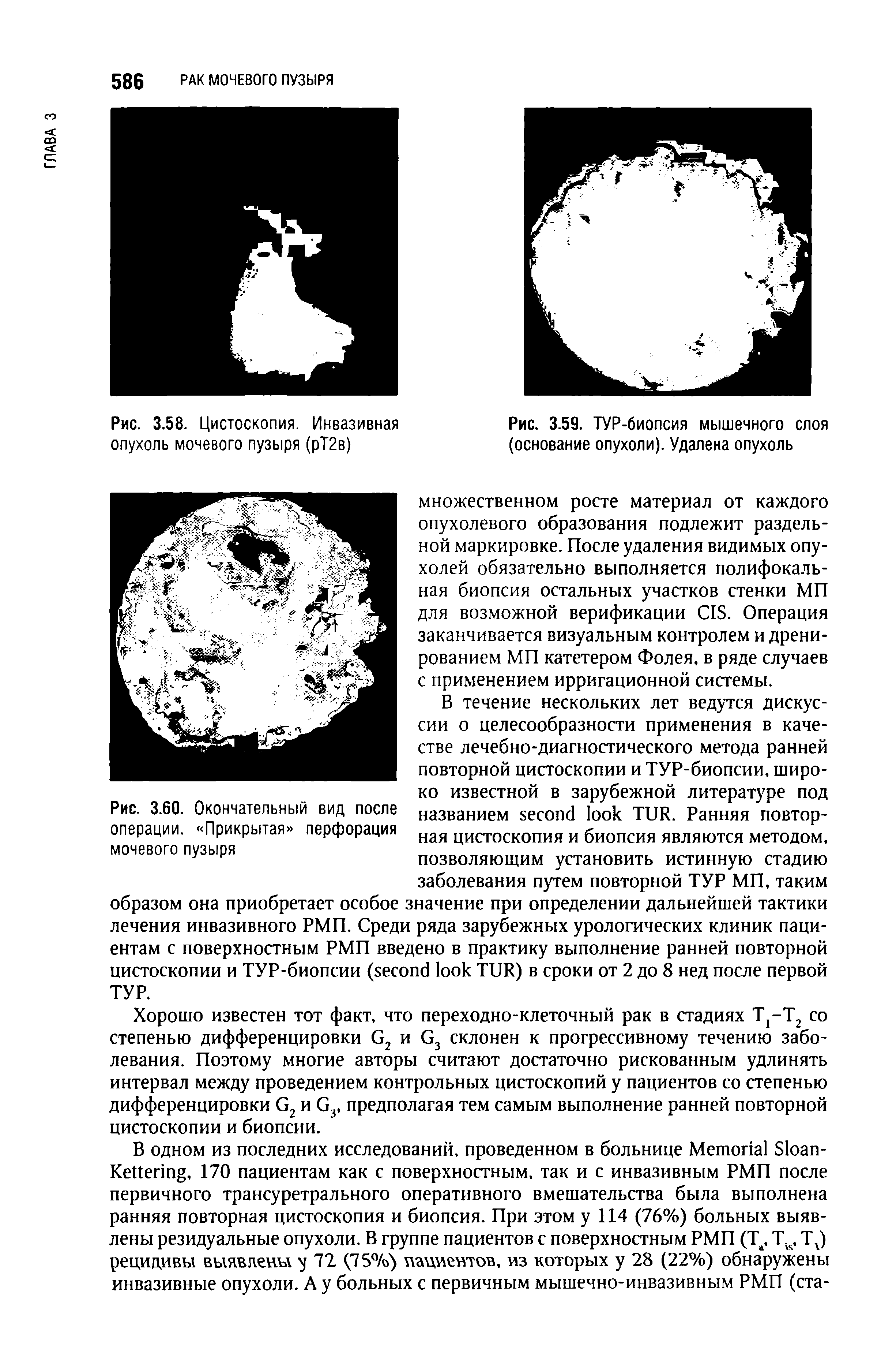 Рис. 3.59. ТУР-биопсия мышечного слоя (основание опухоли). Удалена опухоль...