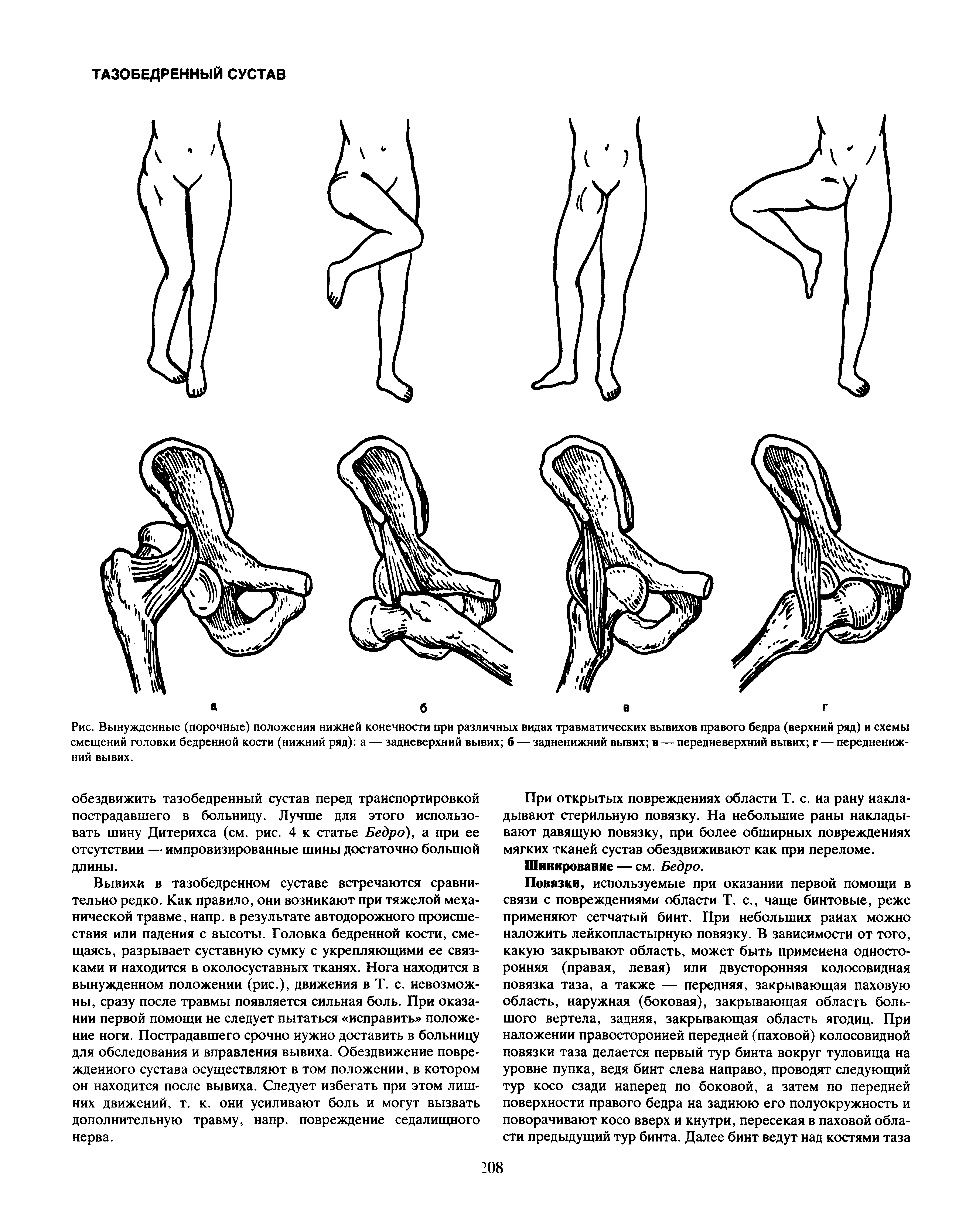 Рис. Вынужденные (порочные) положения нижней конечности при различных видах травматических вывихов правого бедра (верхний ряд) и схемы смещений головки бедренной кости (нижний ряд) а — задневерхний вывих б — задненижний вывих в — передневерхний вывих г — передненижний вывих.