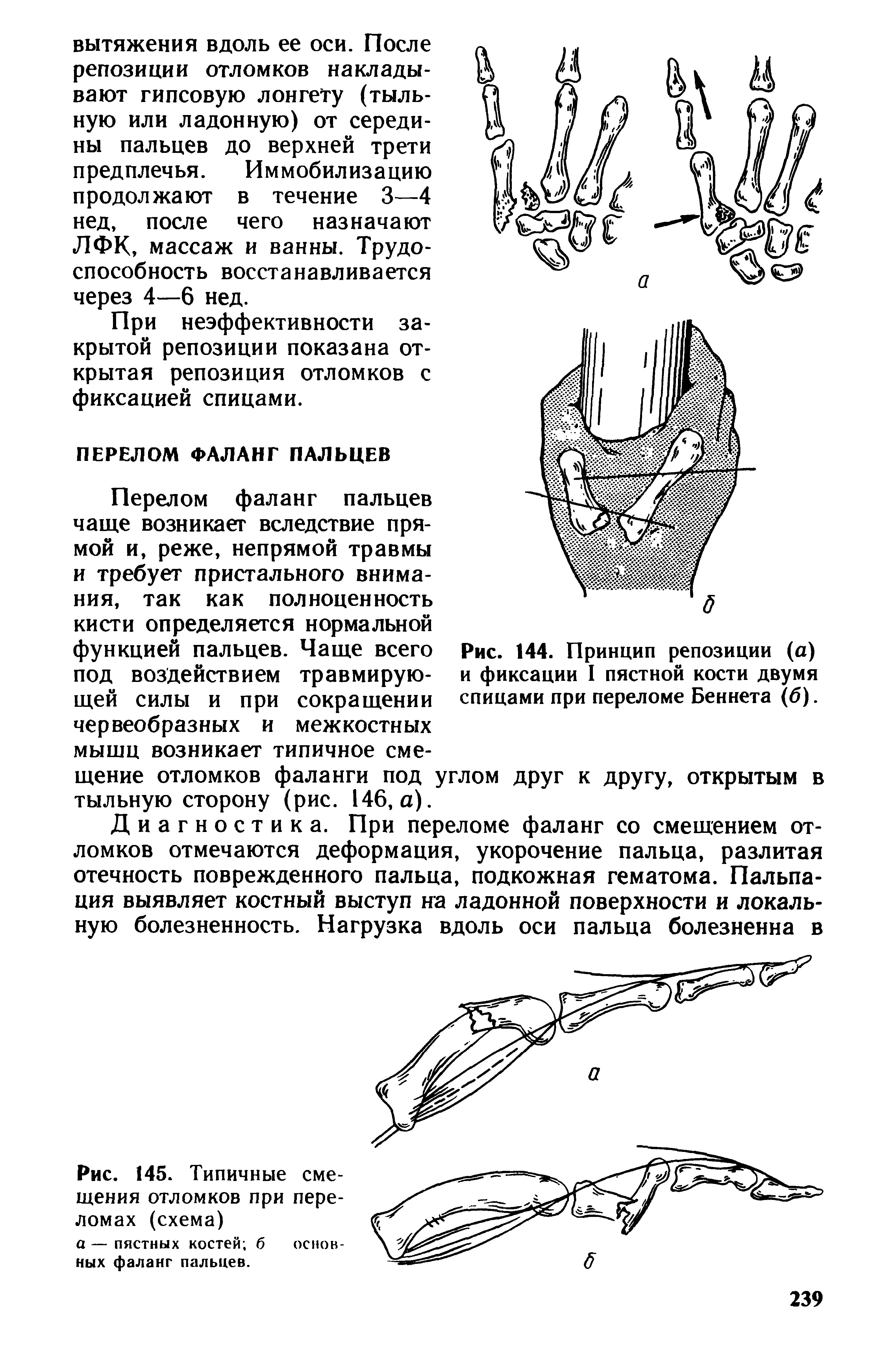 Рис. 144. Принцип репозиции (а) и фиксации I пястной кости двумя спицами при переломе Беннета (б).