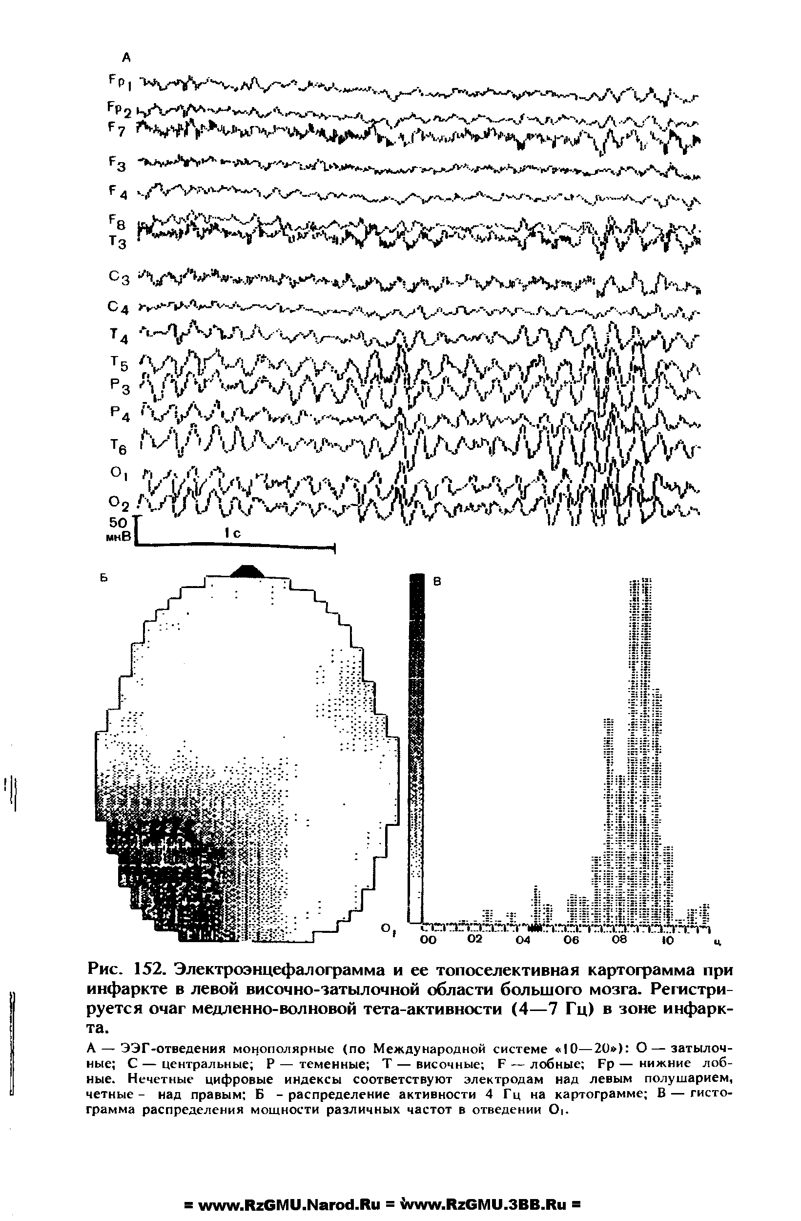 Рис. 152. Электроэнцефалограмма и ее топоселективная картограмма при инфаркте в левой височно-затылочной области большого мозга. Регистрируется очаг медленно-волновой тета-активности (4—7 Гц) в зоне инфаркта.