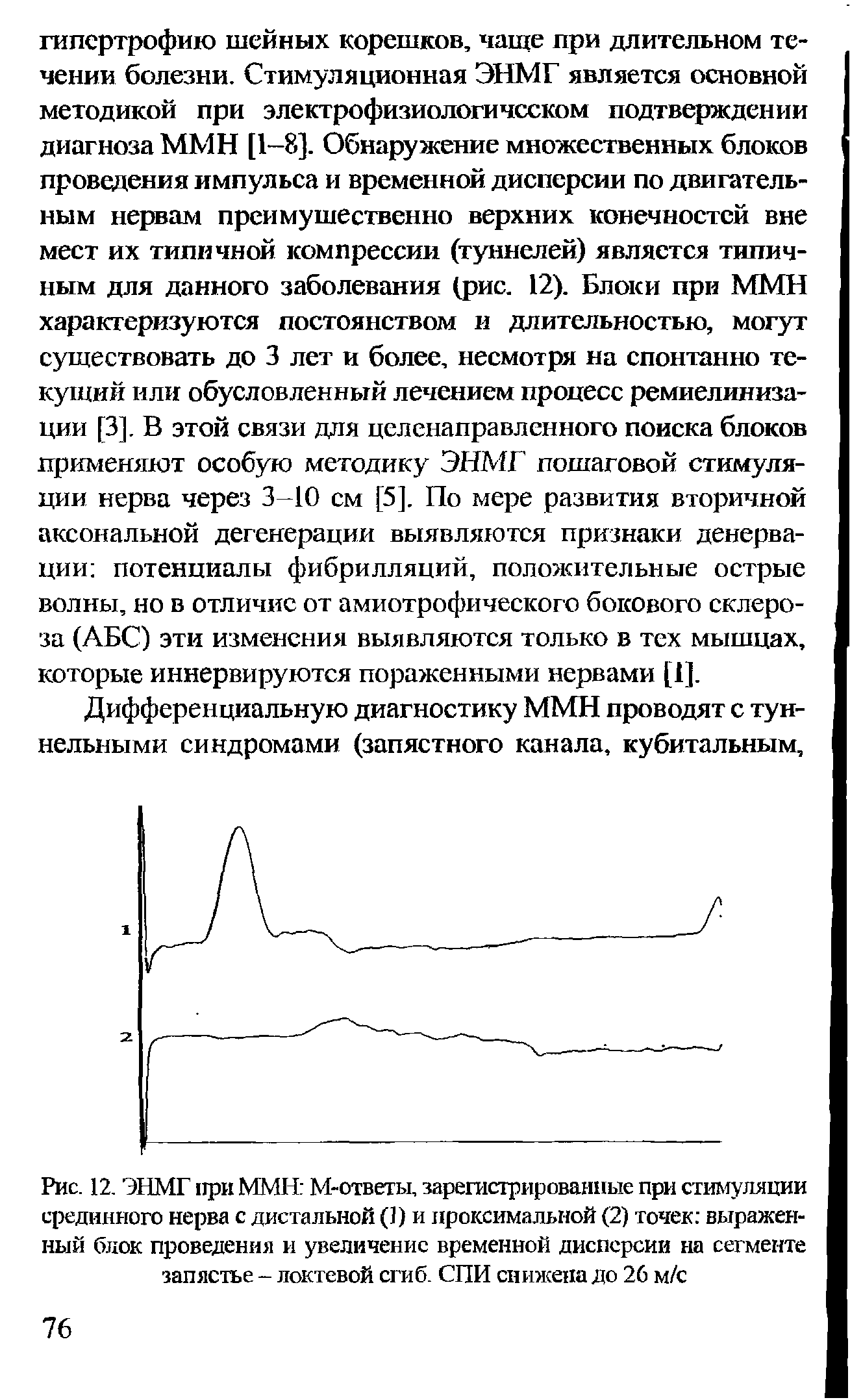 Рис. 12. ЭНМГ при ММН М-ответы, зарегистрированные при стимуляции срединного нерва с дистальной (1) и проксимальной (2) точек выраженный блок проведения и увеличение временной дисперсии на сегменте запястье - локтевой сгиб. СПИ снижена до 26 м/с...