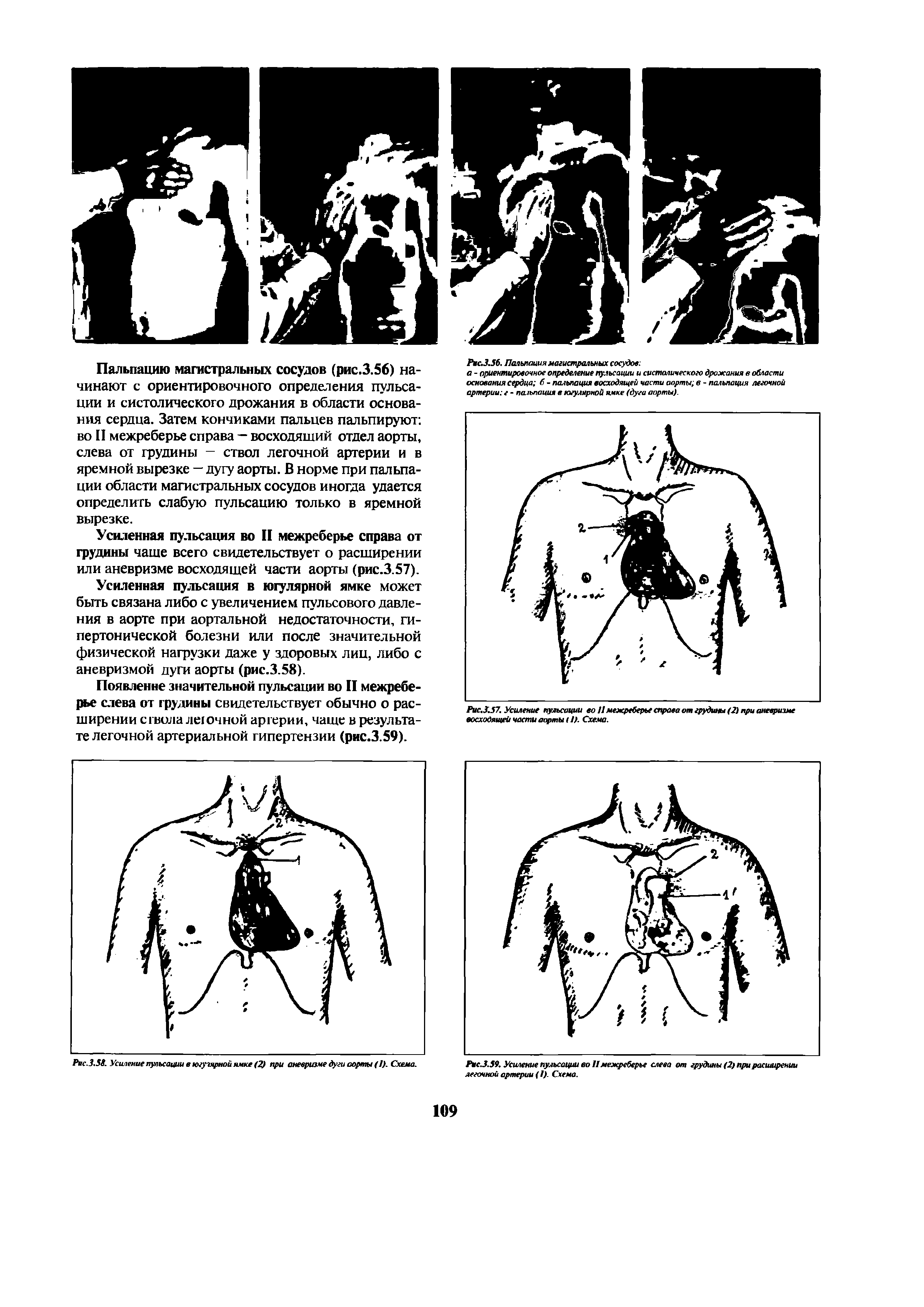 Рис.3.57. Усиление пульсации во 11 межреберье справа от грудины (2) при аневризме восходящей части аорты <1). Схема.