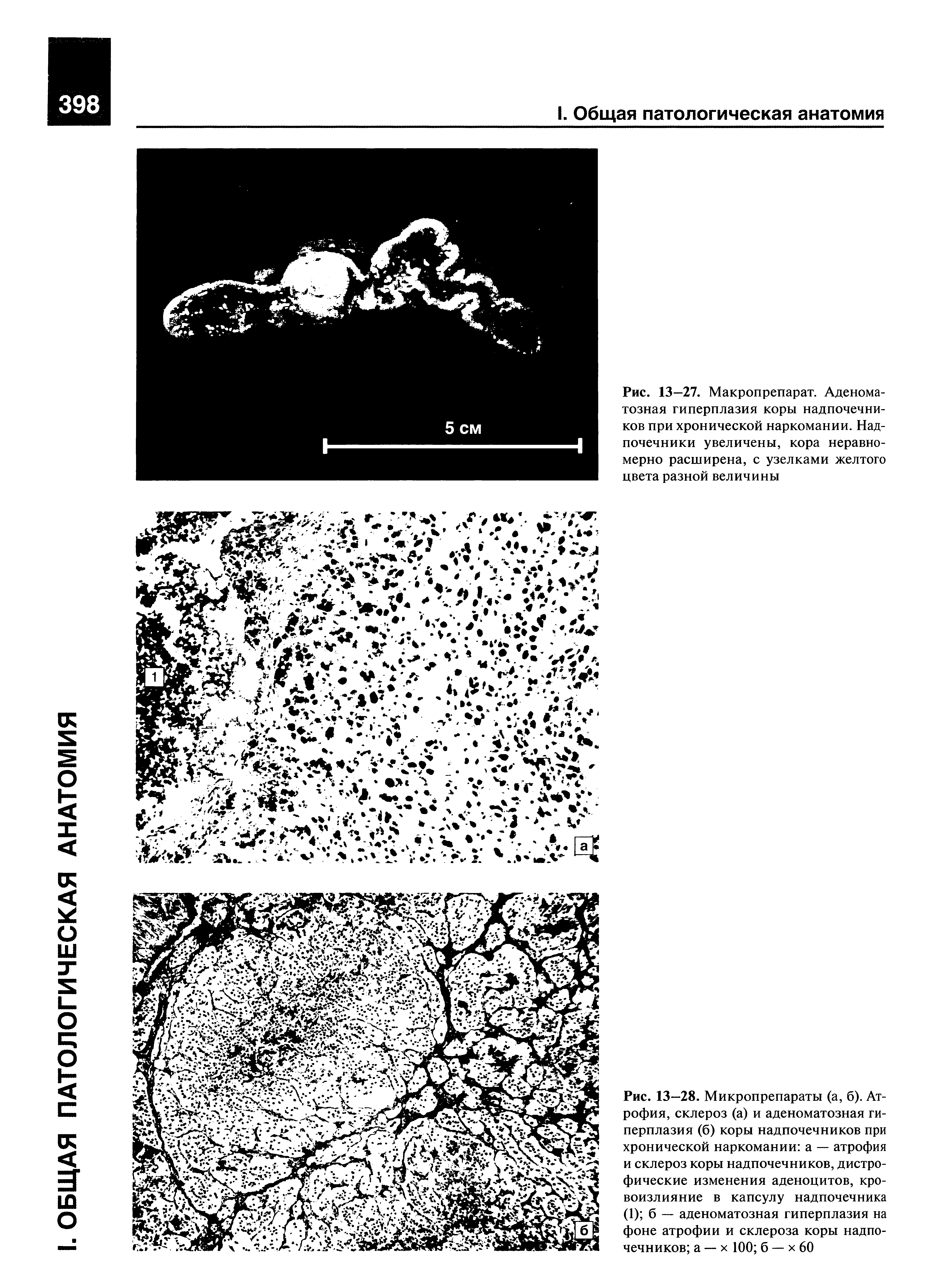 Рис. 13—28. Микропрепараты (а, б). Атрофия, склероз (а) и аденоматозная гиперплазия (б) коры надпочечников при хронической наркомании а — атрофия и склероз коры надпочечников, дистрофические изменения аденоцитов, кровоизлияние в капсулу надпочечника (1) б — аденоматозная гиперплазия на фоне атрофии и склероза коры надпочечников а —- х 100 б — х 60...
