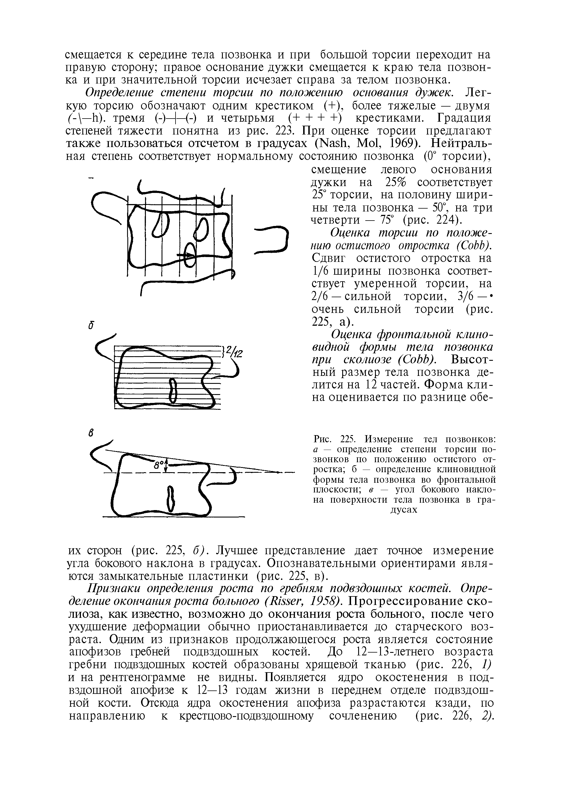 Рис. 225. Измерение тел позвонков а — определение степени торсии позвонков по положению остистого отростка б — определение клиновидной формы тела позвонка во фронтальной плоскости в — угол бокового наклона поверхности тела позвонка в градусах...