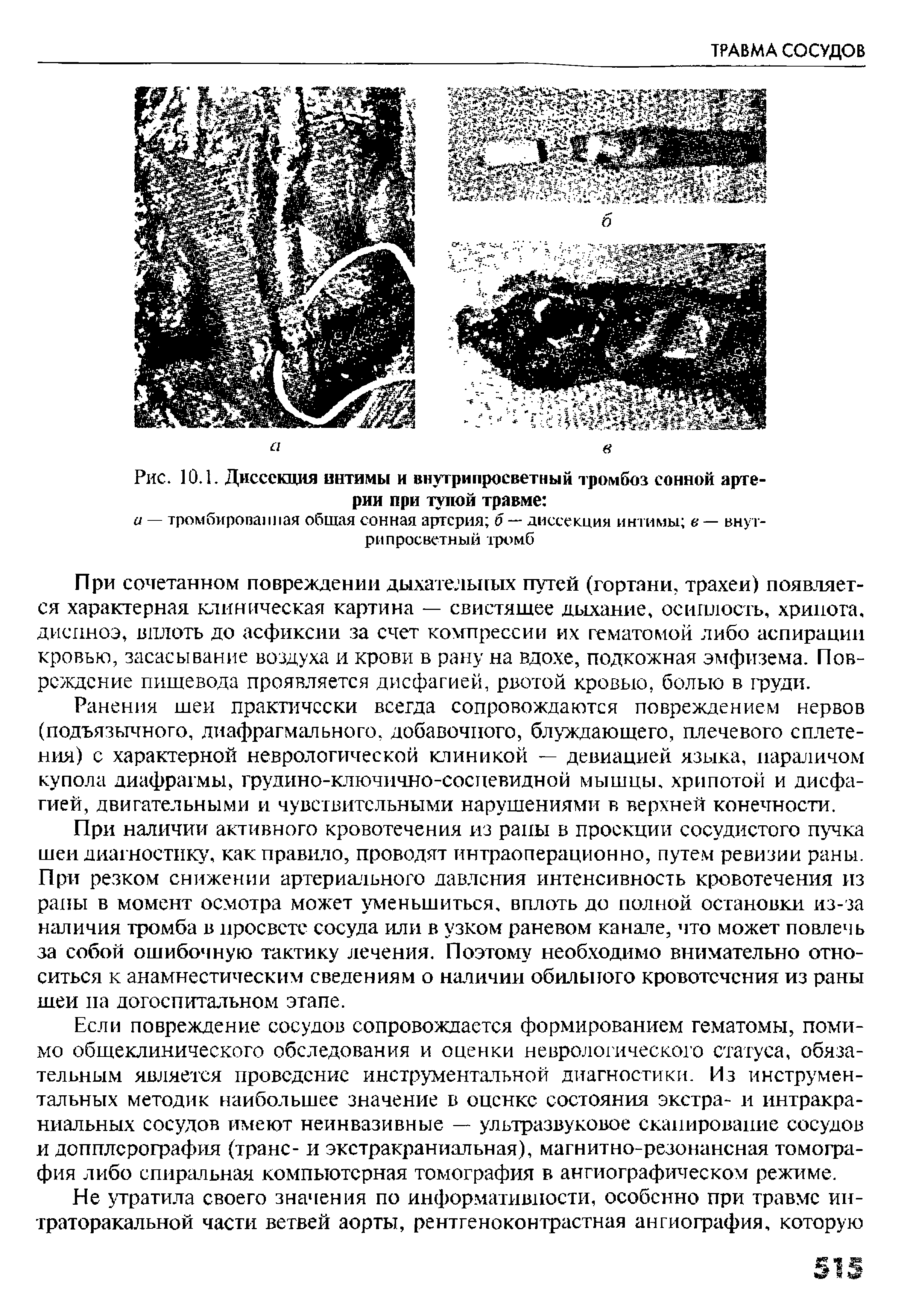 Рис. 10.1. Диссекция интимы и внутрипросветный тромбоз сонной артерии при тупой травме ...