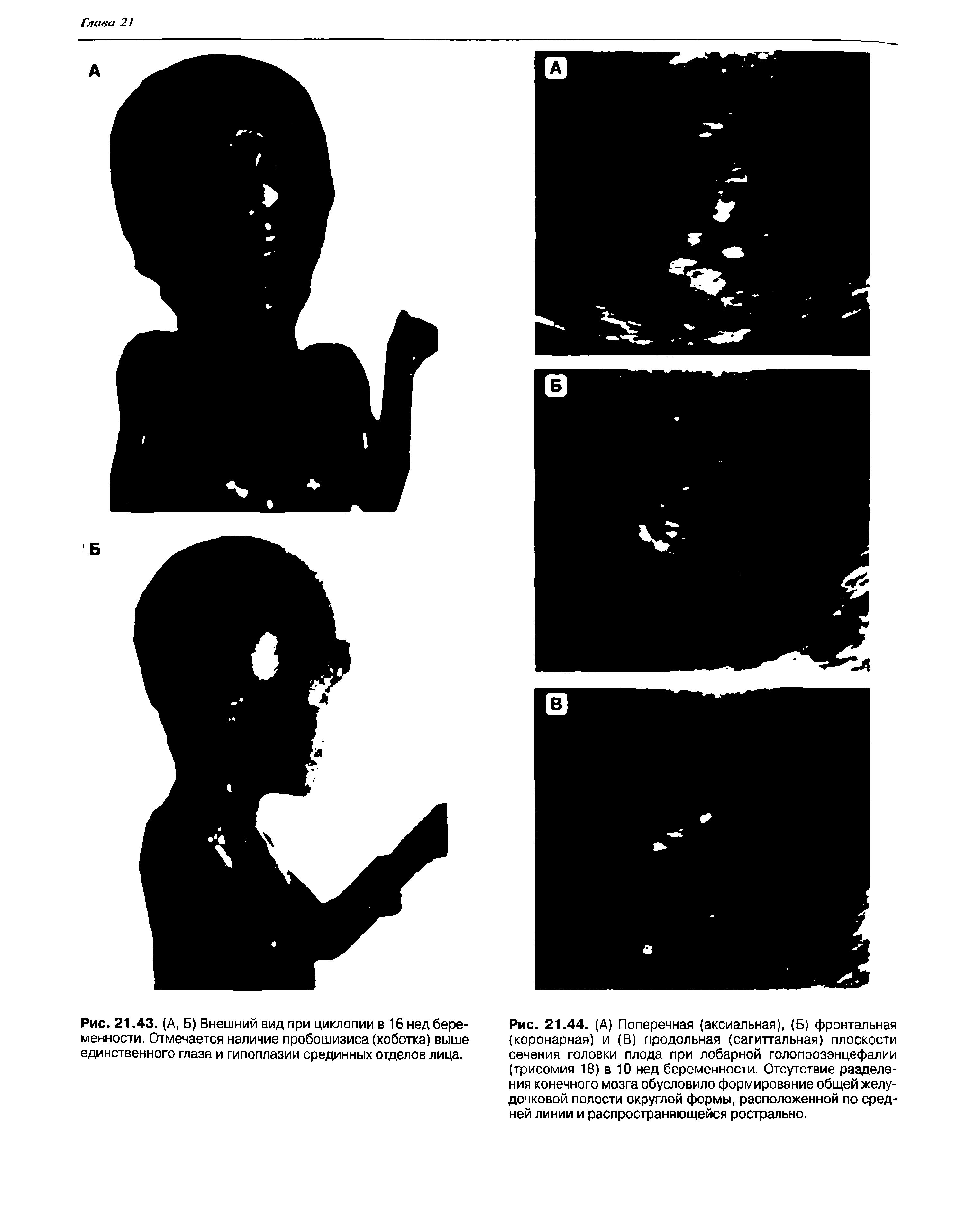 Рис. 21.43. (А, Б) Внешний вид при циклопин в 16 нед беременности. Отмечается наличие пробошизиса (хоботка) выше единственного глаза и гипоплазии срединных отделов лица.