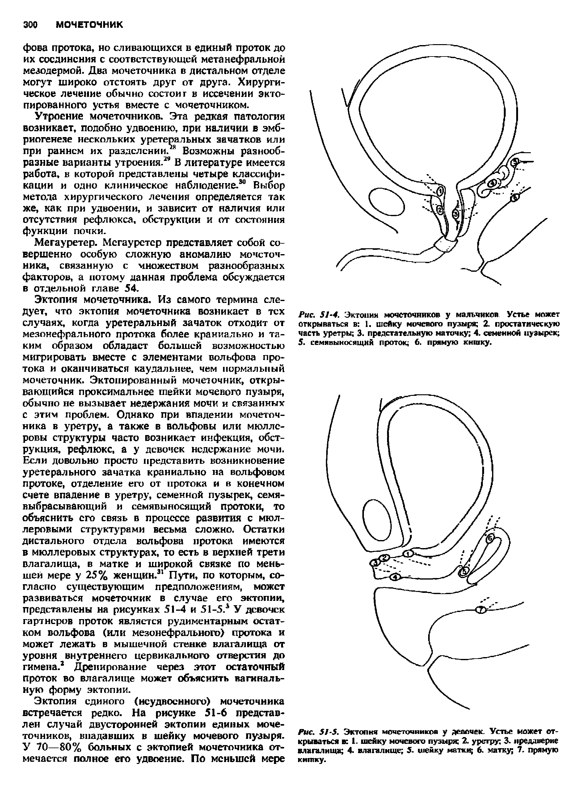 Рис. 5 -5. Эктопня мочеточников у девочек. Устье может открываться в 1- шейку мочевого пузыря X уретру 3. преддверие влагалища 4. влагалище 5. шейку матки 6. матку 7. прямую кнпгку.