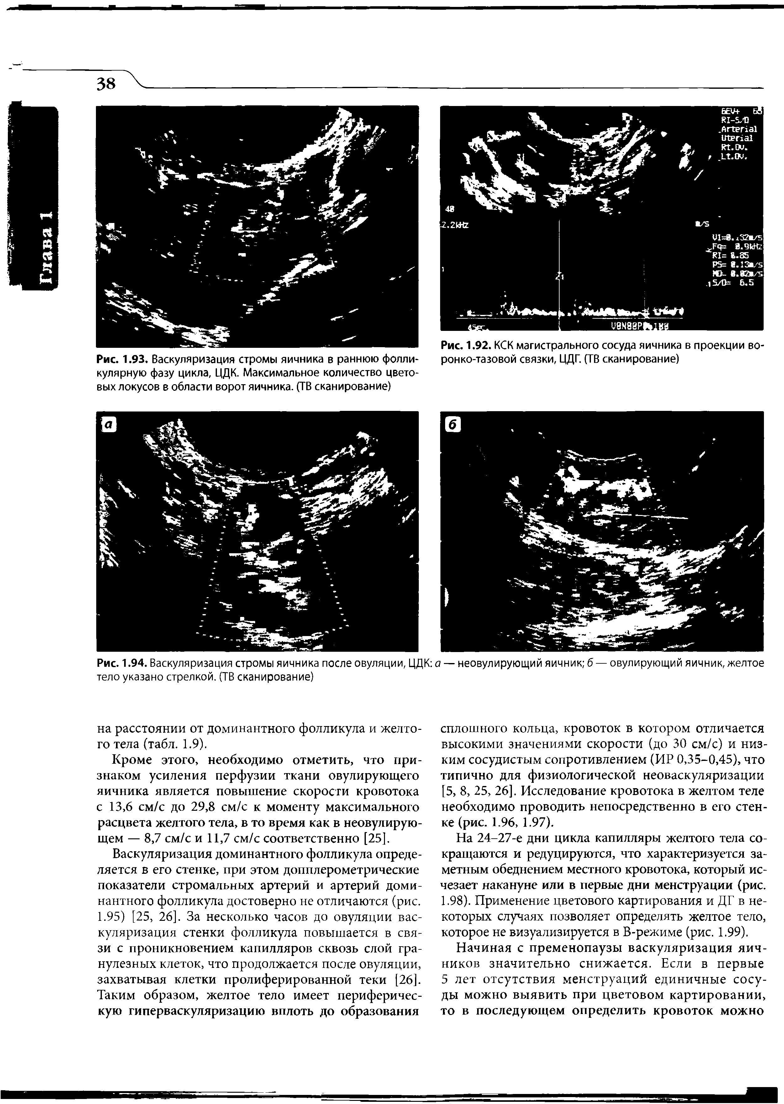 Рис. 1.94. Васкуляризация стромы яичника после овуляции, ЦДК а — неовулирующий яичник б — овулирующий яичник, желтое тело указано стрелкой. (ТВ сканирование)...