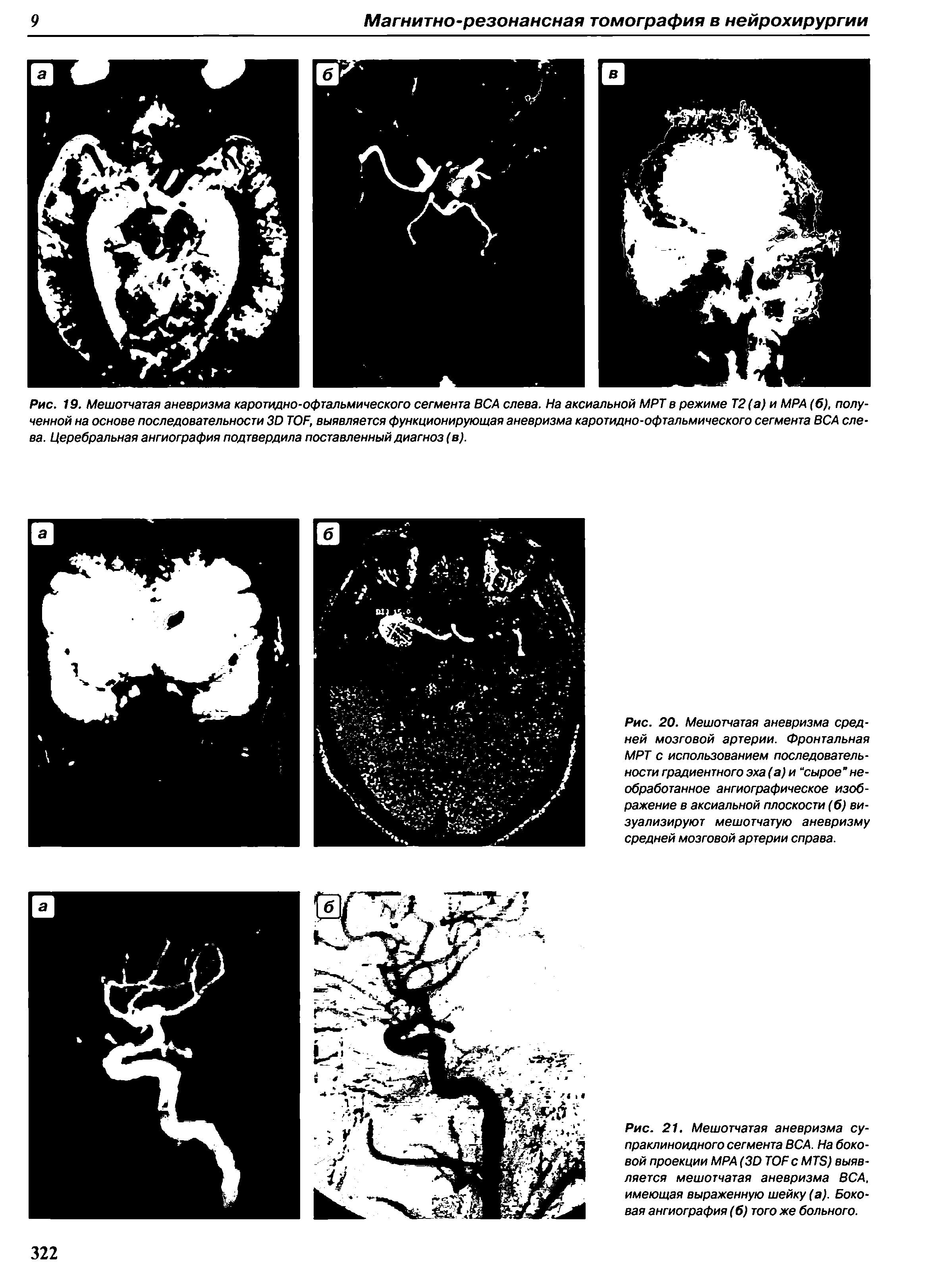 Рис. 20. Мешотчатая аневризма средней мозговой артерии. Фронтальная МРТ с использованием последовательности градиентного эха (а) и сырое" необработанное ангиографическое изображение в аксиальной плоскости (б) визуализируют мешотчатую аневризму средней мозговой артерии справа.