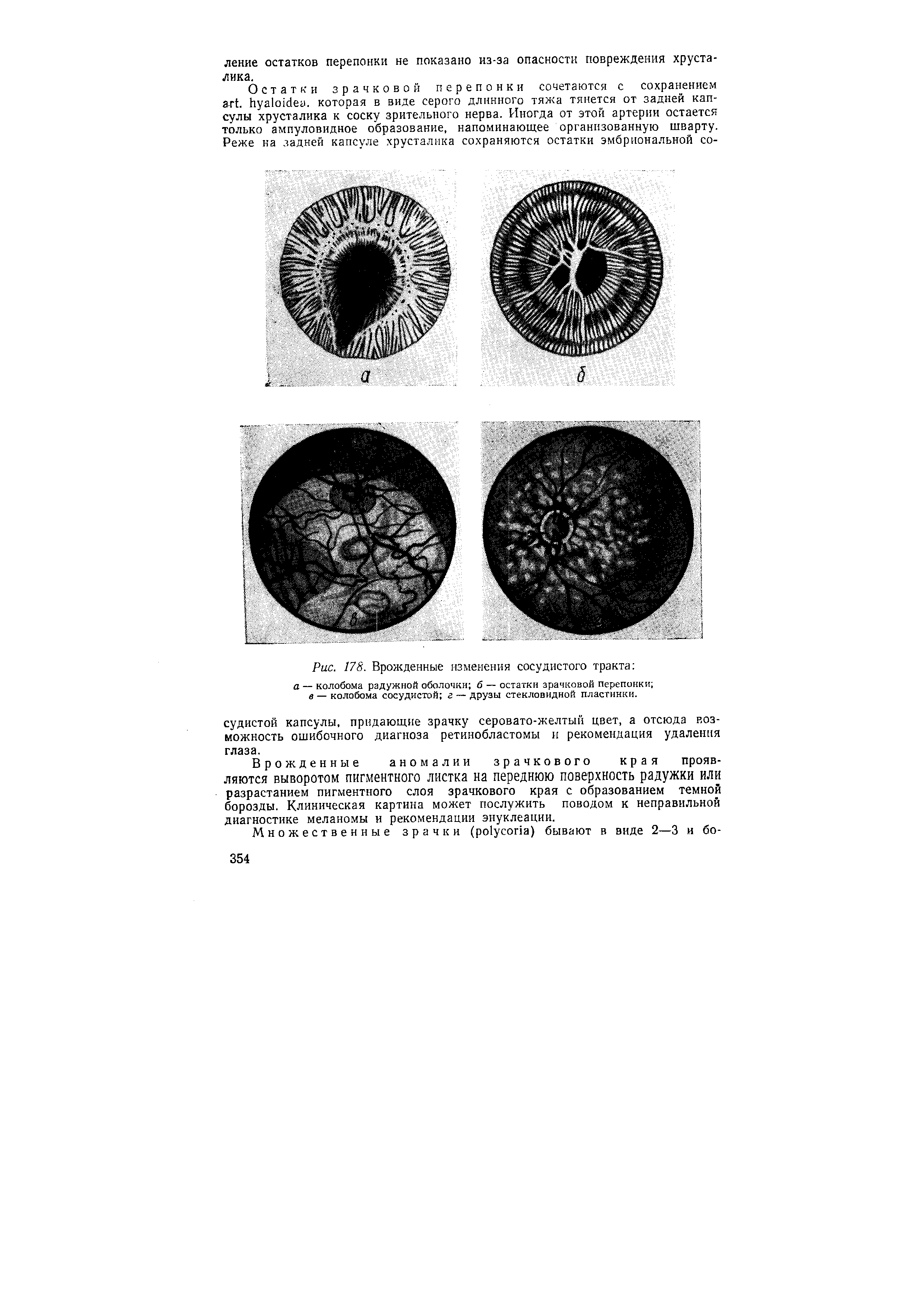 Рис. 178. Врожденные изменения сосудистого тракта а — колобома радужной оболочки б — остатки зрачковой перепонки в — колобома сосудистой г — Друзы стекловидной пластинки.