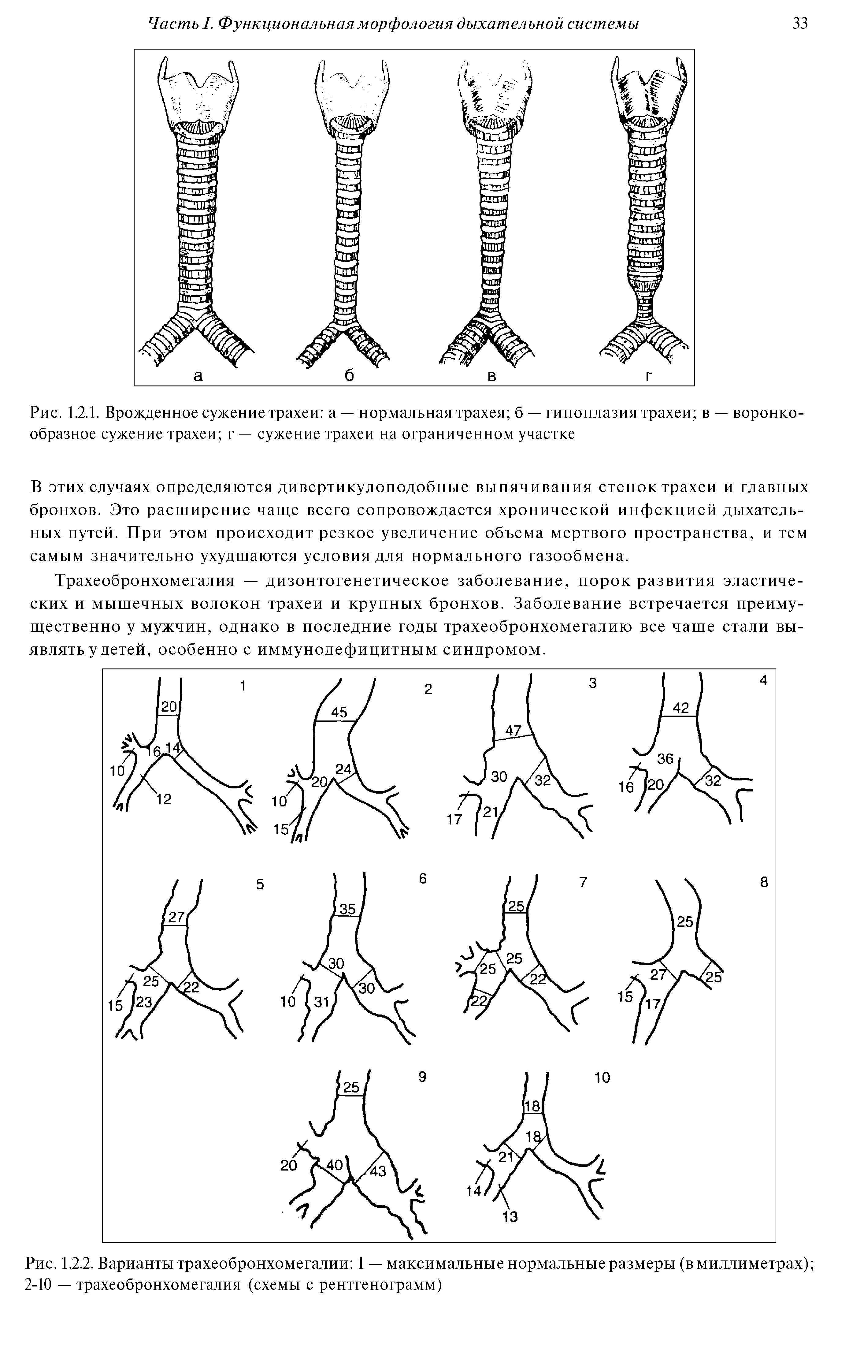 Рис. 1.2.1. Врожденное сужение трахеи а — нормальная трахея б — гипоплазия трахеи в — воронкообразное сужение трахеи г — сужение трахеи на ограниченном участке...
