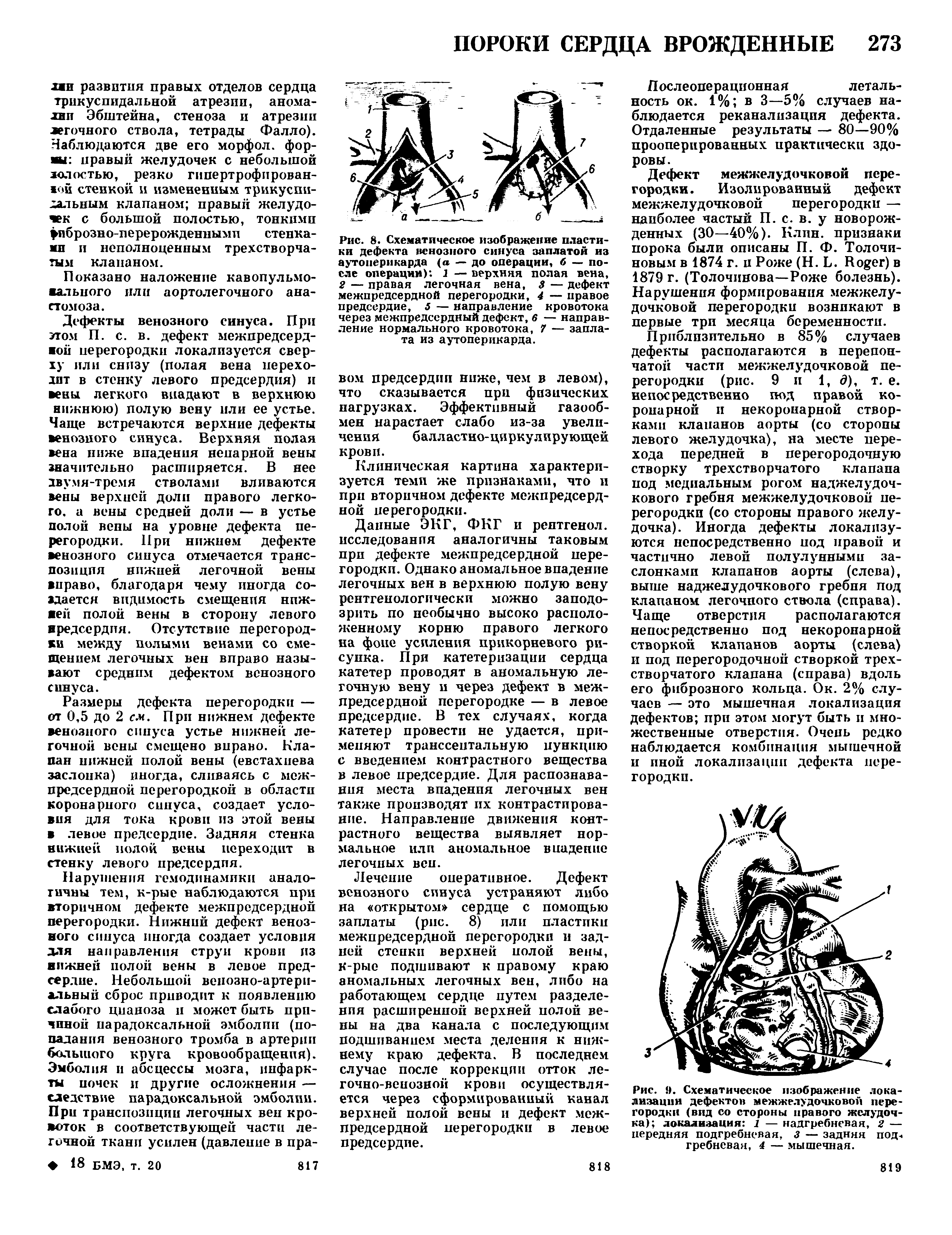 Рис. 9. Схематическое изображение локализации дефектов межжелудочковой перегородки (вид со стороны правого желудочка) локализация 1 — надгребневая, 2 — передняя подгребневая, з — задняя под-, гребневая, 4 — мышечная.