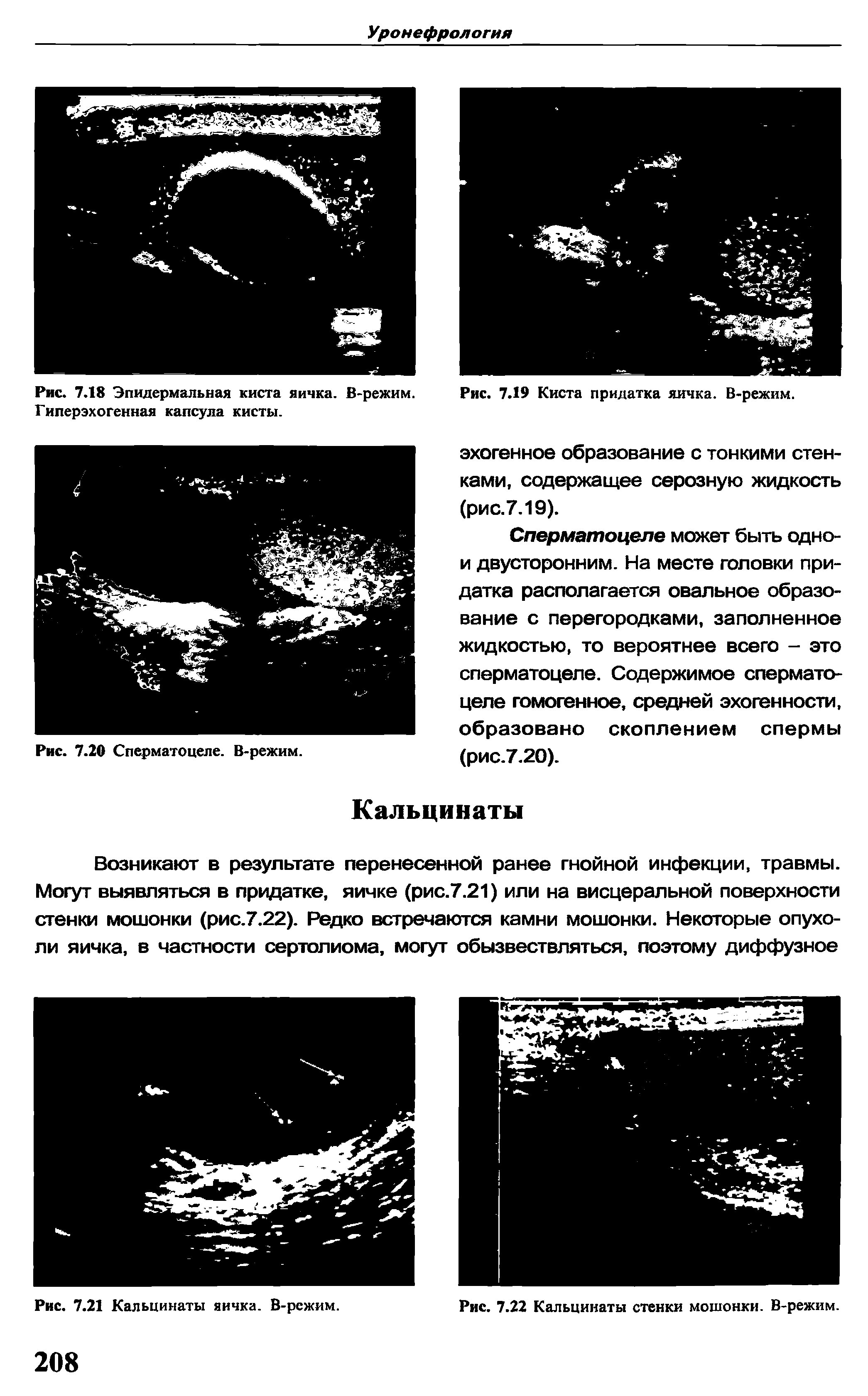 Рис. 7.18 Эпидермальная киста яичка. В-режим. Гиперэхогенная капсула кисты.