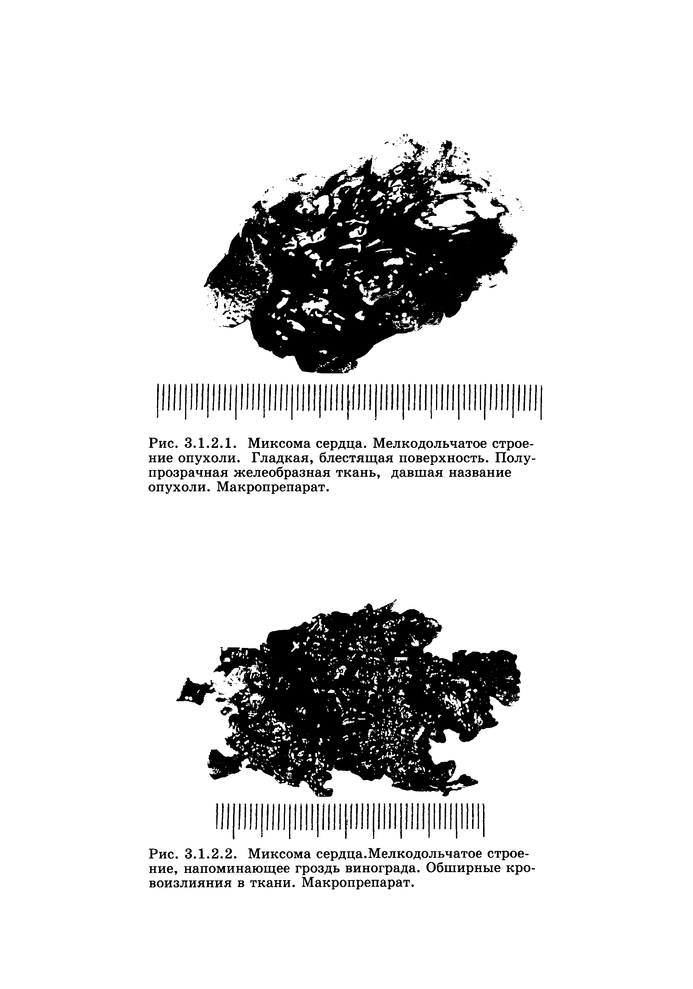 Рис. 3.1.2.1. Миксома сердца. Мелкодольчатое строение опухоли. Гладкая, блестящая поверхность. Полупрозрачная желеобразная ткань, давшая название опухоли. Макропрепарат.