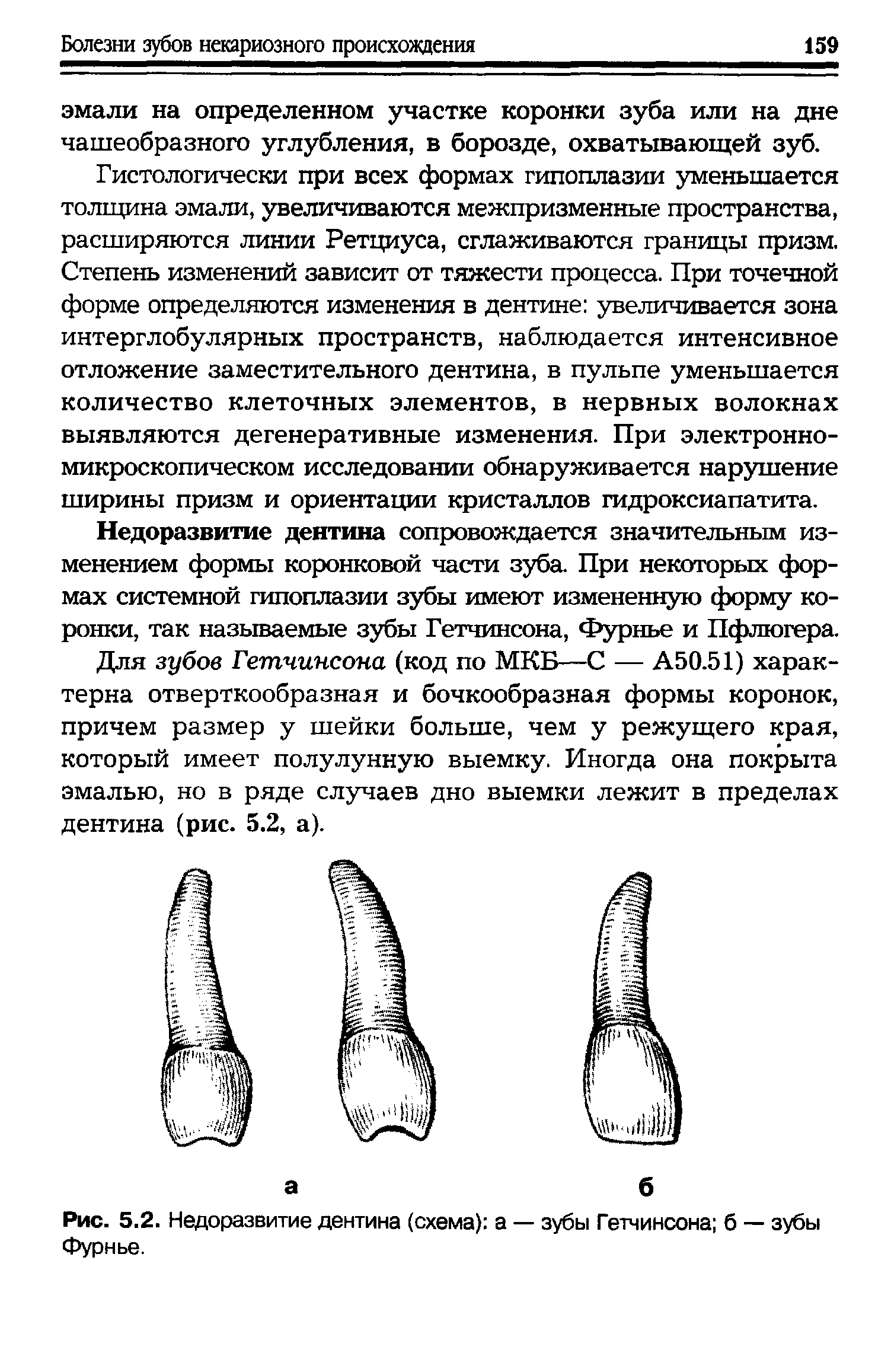 Рис. 5.2. Недоразвитие дентина (схема) а — зубы Гетчинсона б — зубы Фурнье.