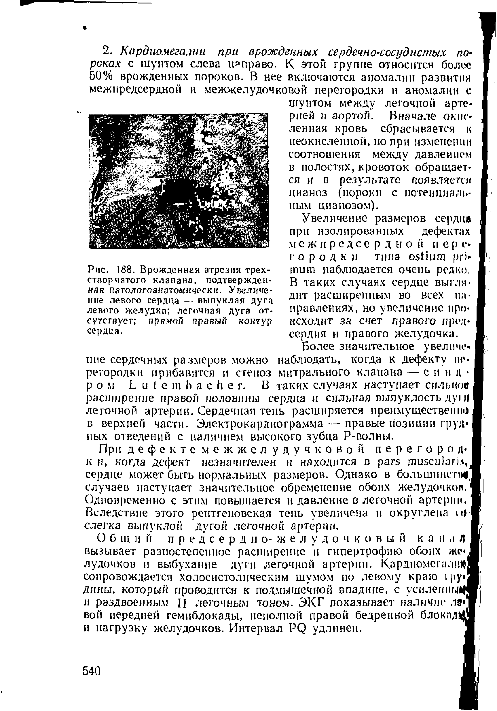 Рис. 188. Врожденная атрезия трехстворчатого клапана, подтвержденная патологоанатомически. Увеличение левого сердца — выпуклая дуга левого желудка легочная дуга отсутствует прямой правый контур сердца.