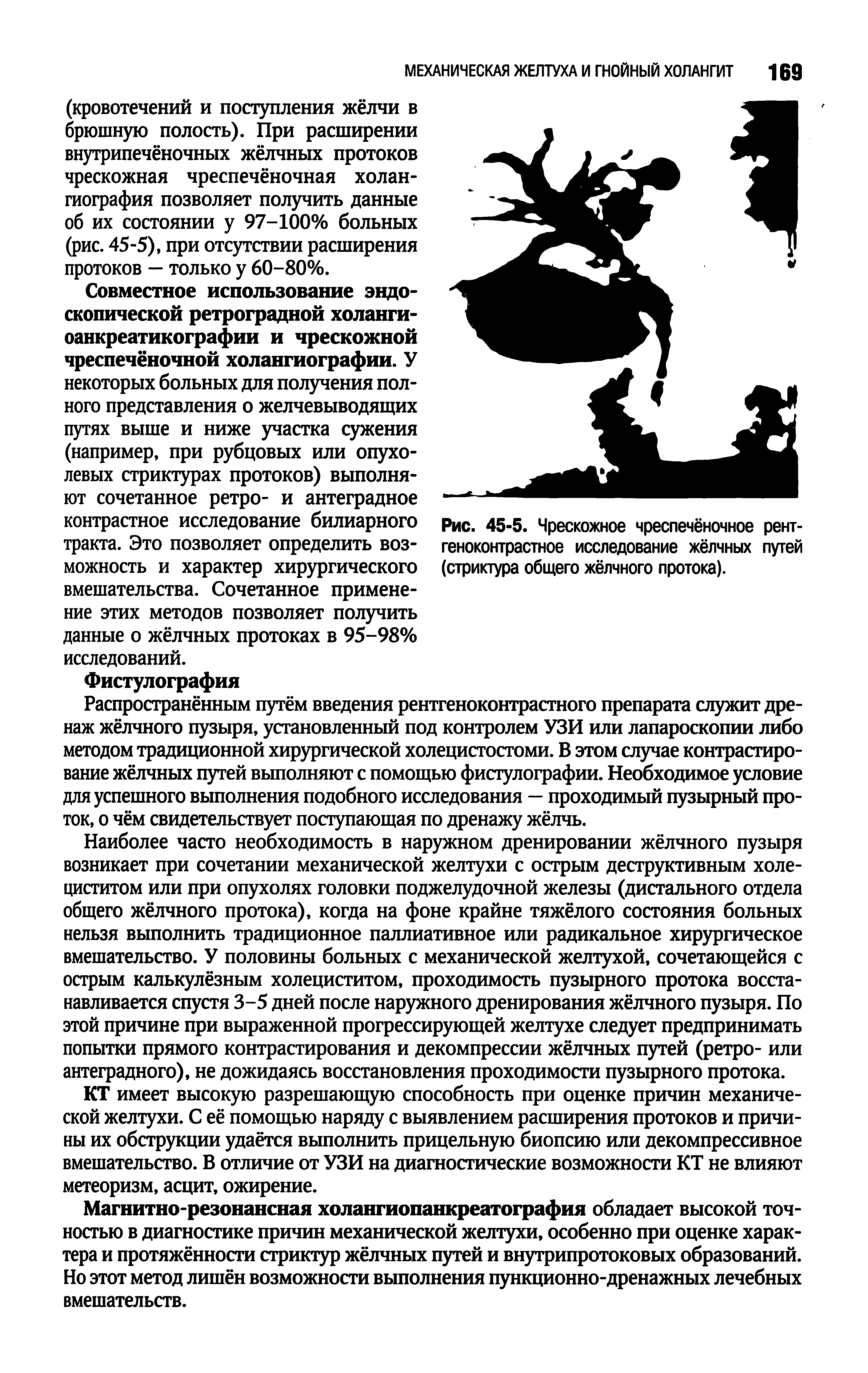 Рис. 45-5. Чрескожное чреспечёночное рентгеноконтрастное исследование жёлчных путей (стриктура общего жёлчного протока).