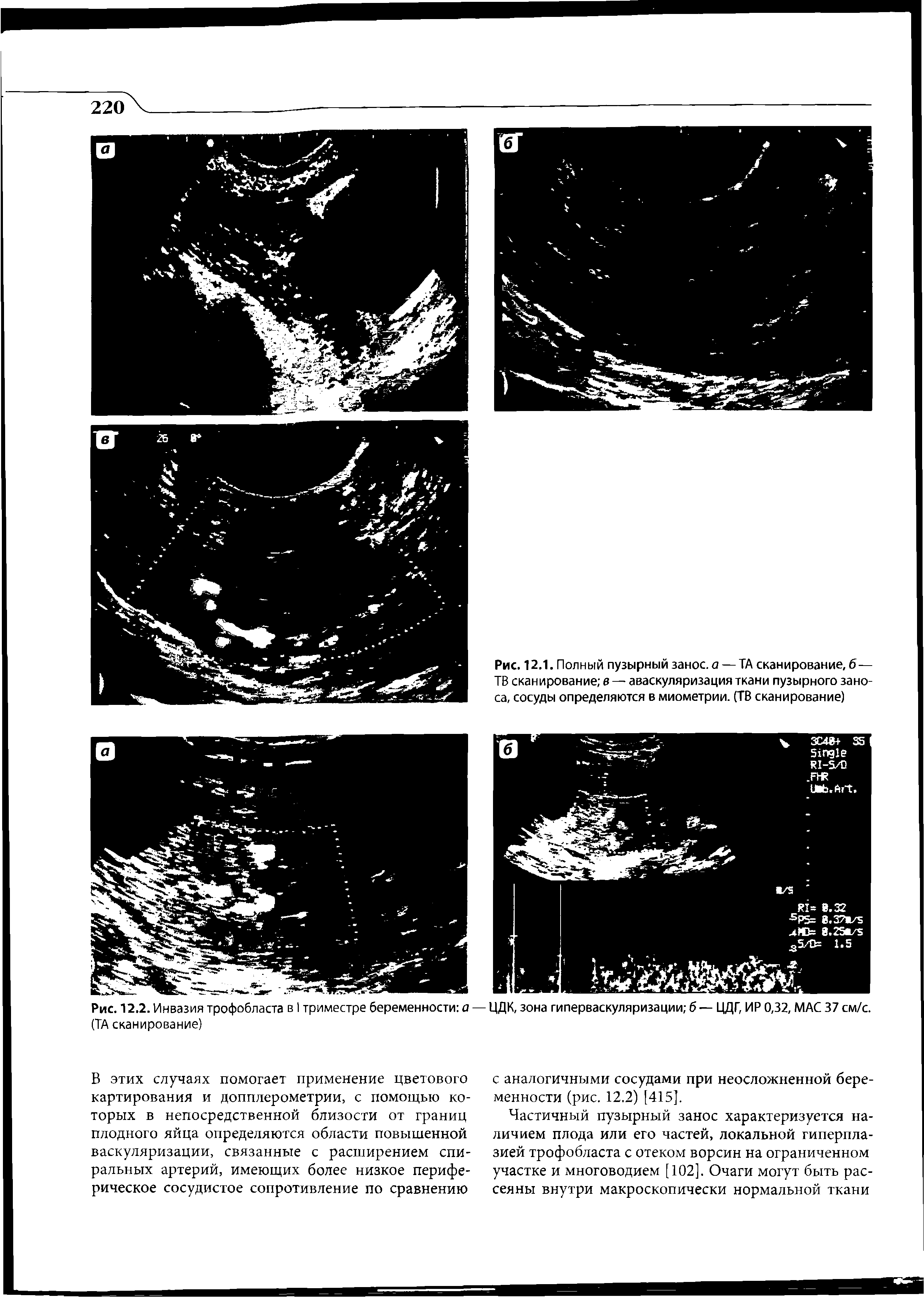 Рис. 12.2. Инвазия трофобласта в I триместре беременности а — ЦДК, зона гиперваскуляризации б — ЦДГ, ИР 0,32, МАС 37 см/с. (ТА сканирование)...