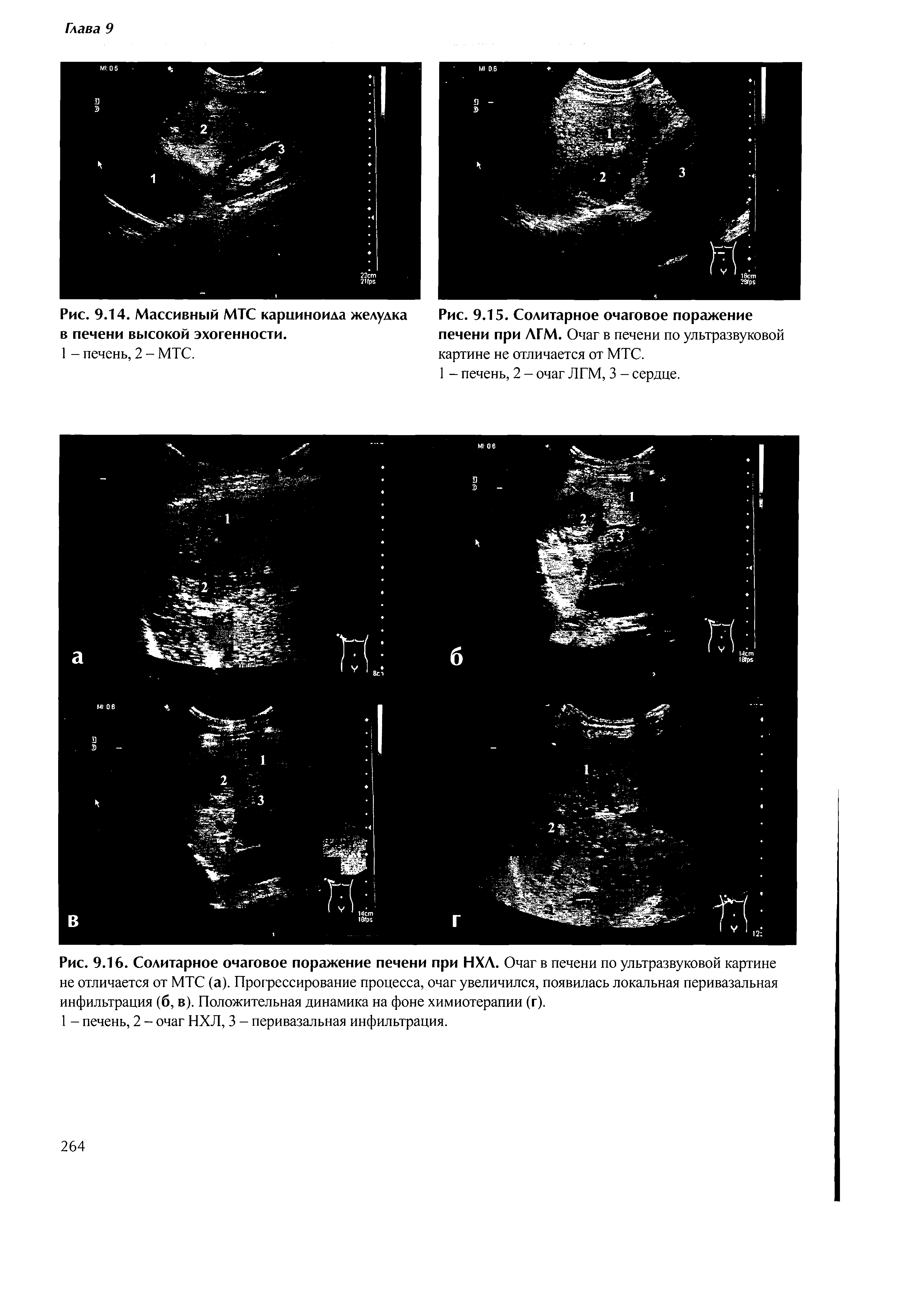 Рис. 9.14. Массивный МТС карциноида желудка в печени высокой эхогенности.